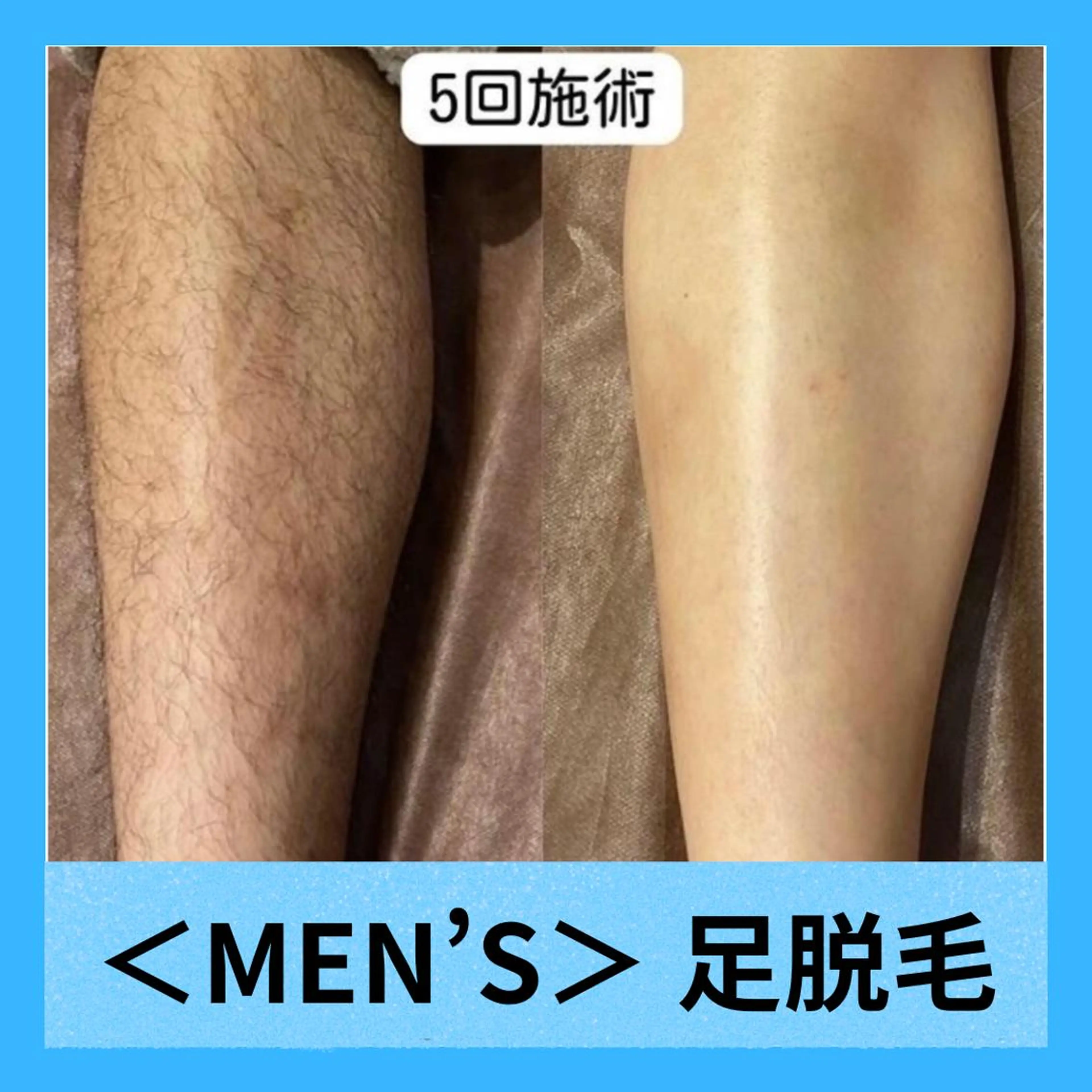 【メンズ脱毛】足の脱毛！1回2.500円　足の甲・指脱毛付の写真