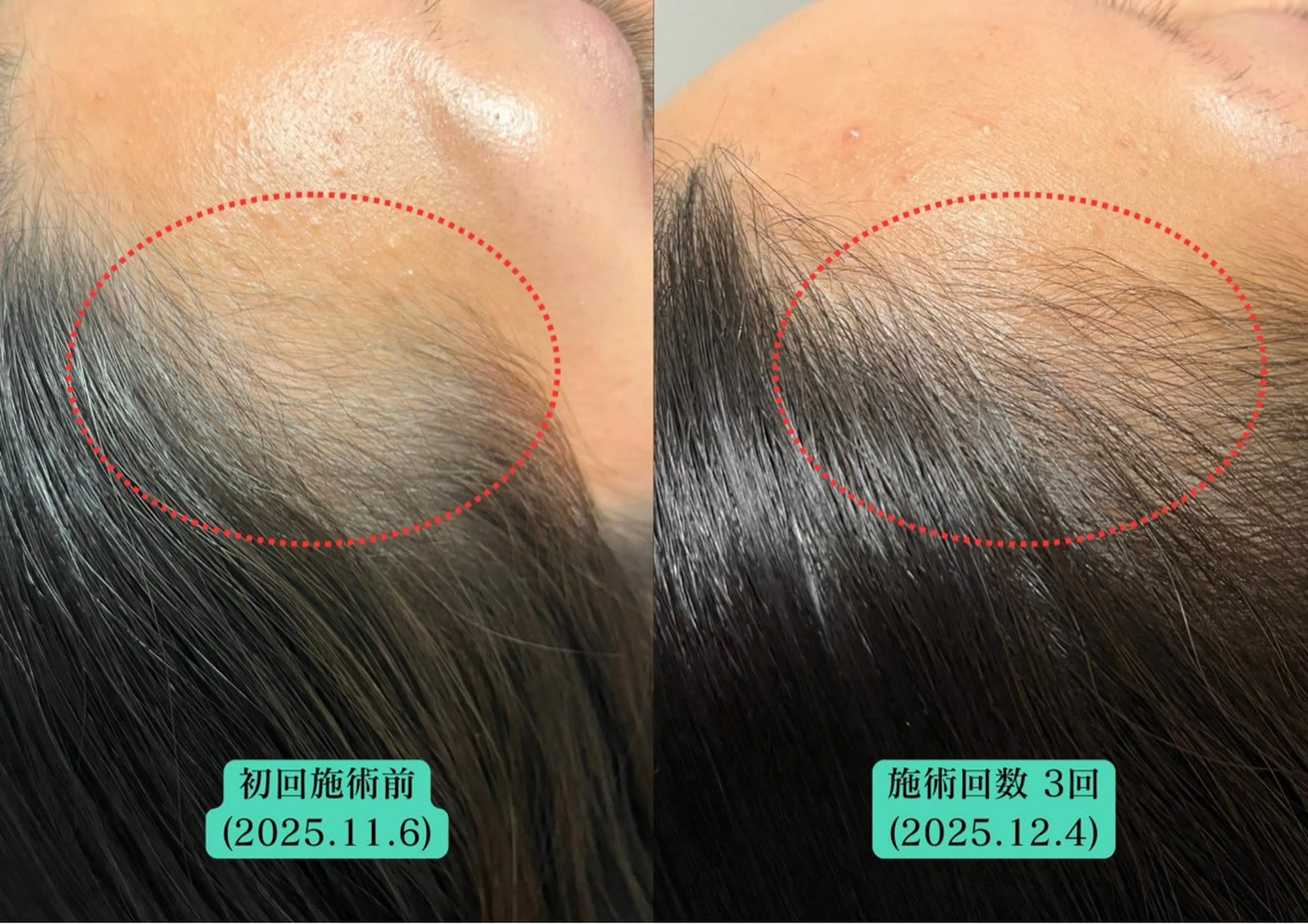 女性専用/初回体験《髪が細くなった/分け目が目立つ/頭皮が透けて見える》髪を育てる鍼+LEDの写真