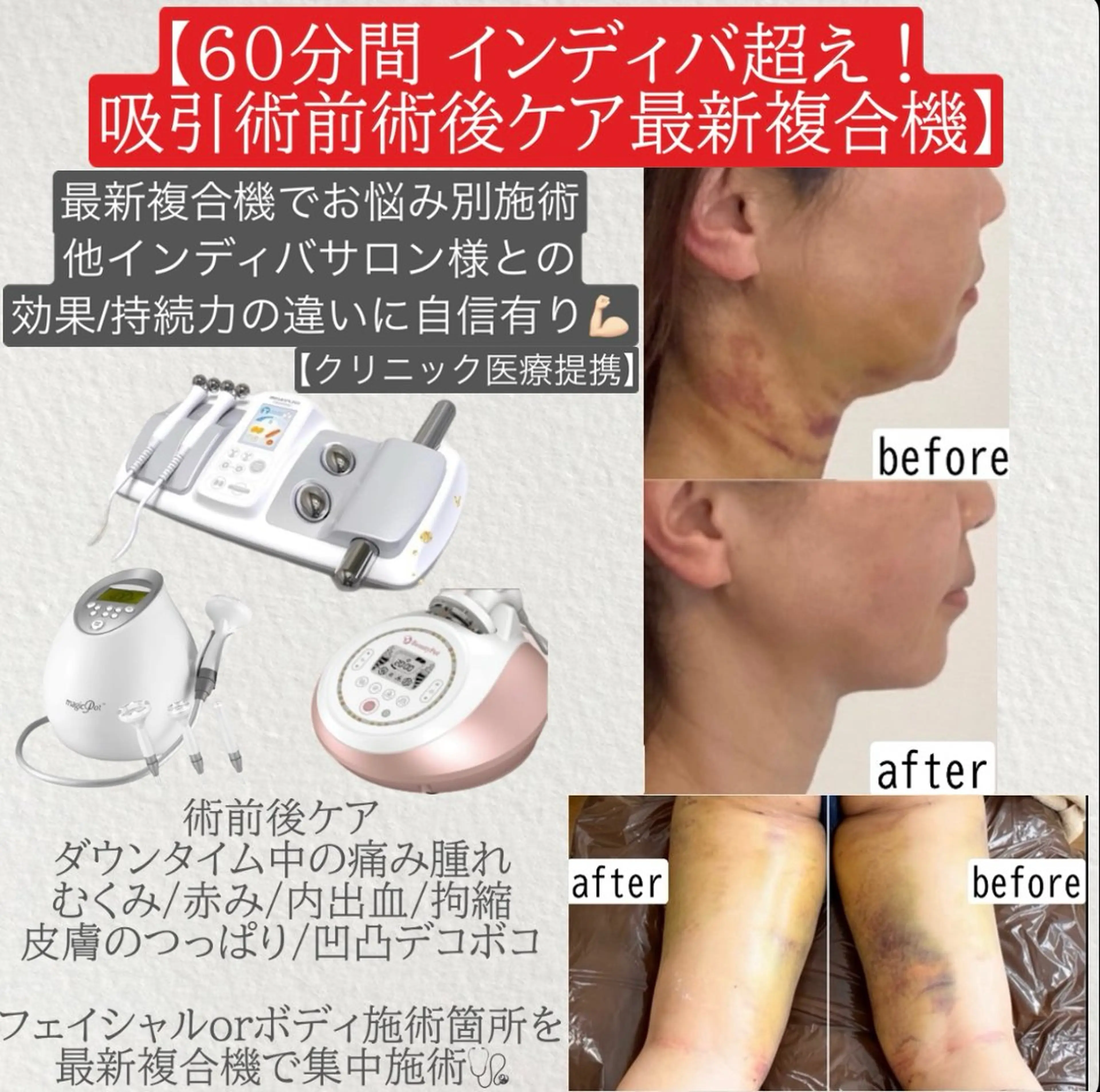 医療提携🩺人気No.2🥈脂肪吸引術前術後ケア🥼最新複合痩身機でインディバ超えの効果に自信アリ💪🏻60分徹底ケアの写真