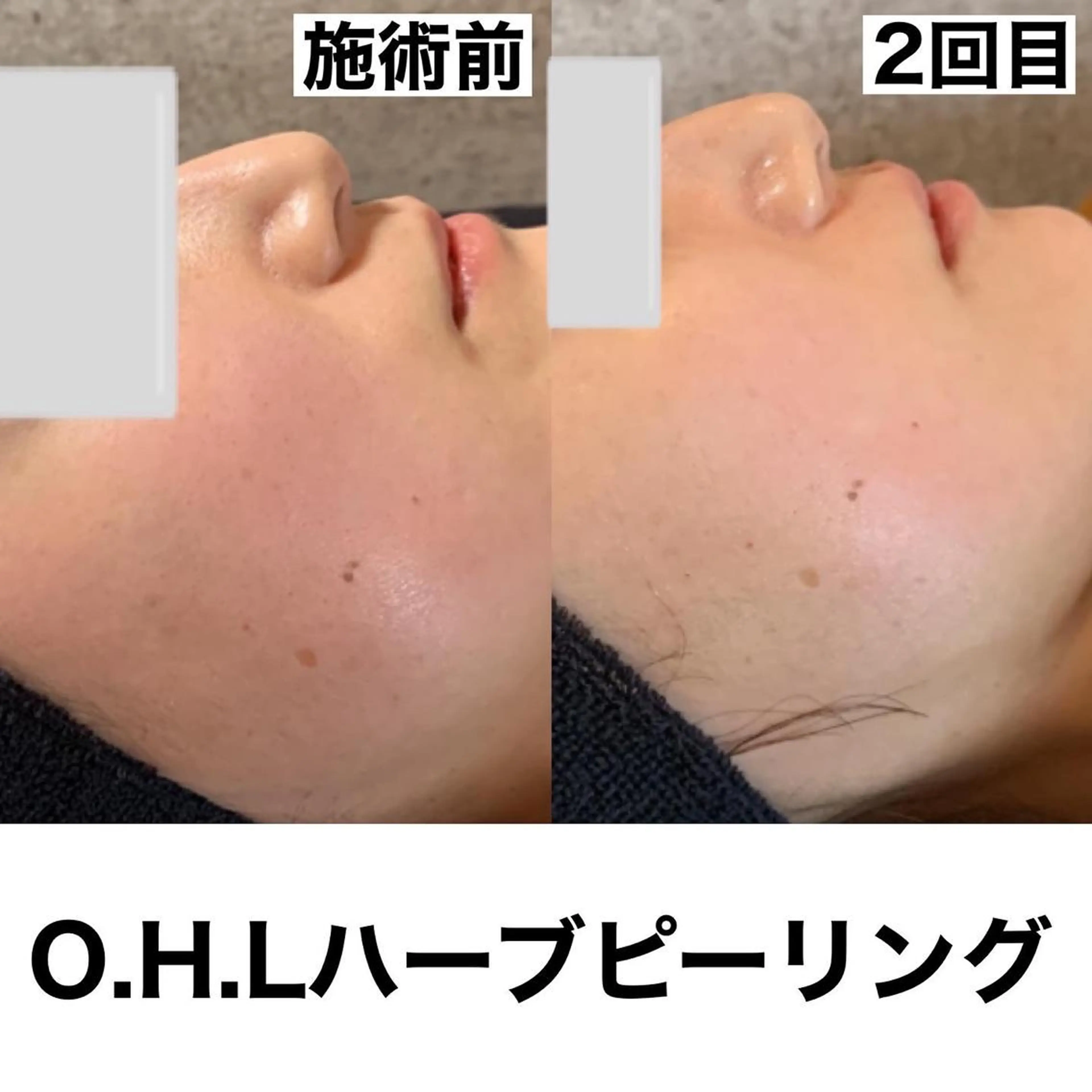 姫路ハーブピーリング・韓国肌管理専門店Emotional所属・Yuka .のエステ・リラクイメージ