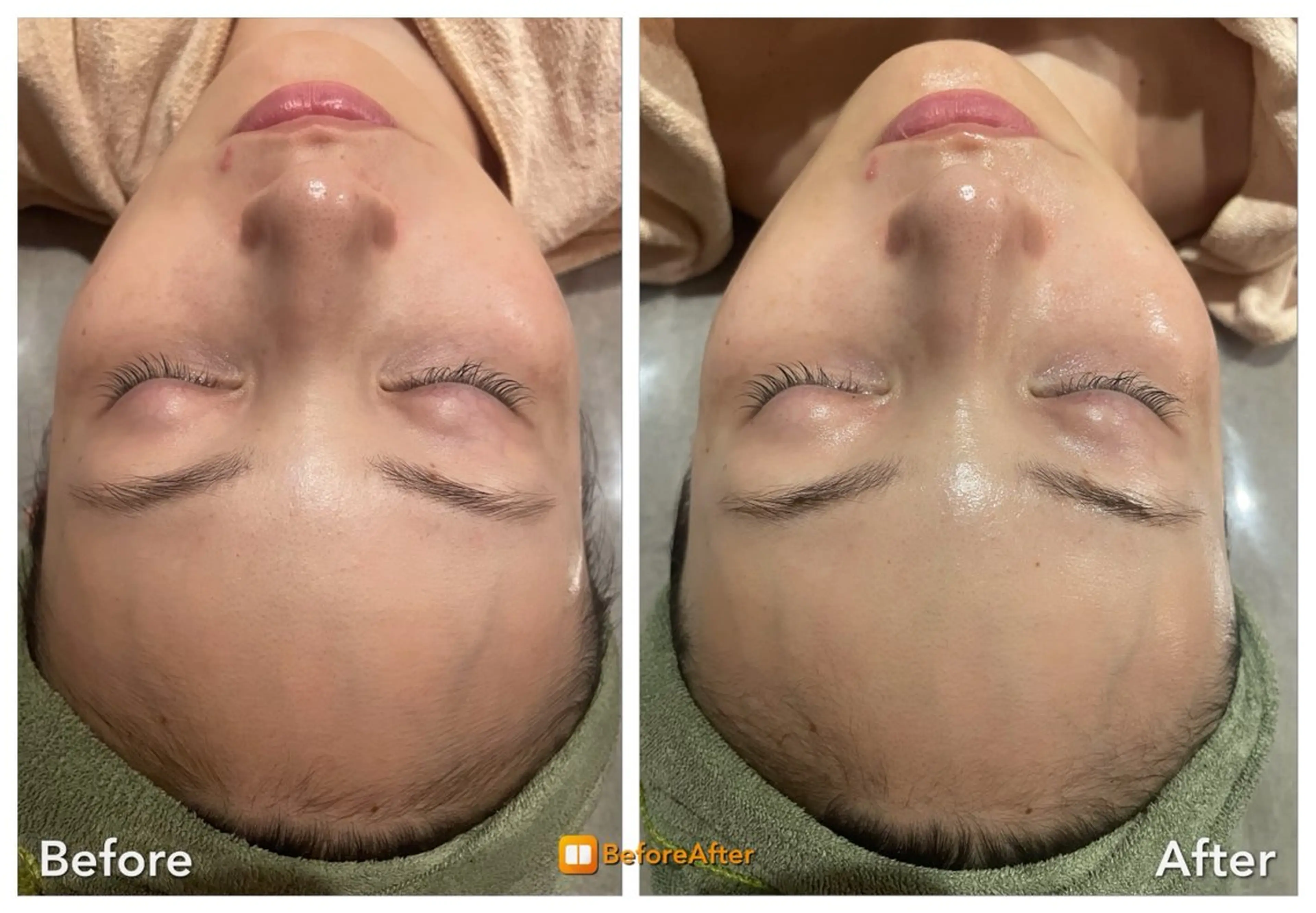 エステ Meupニキビ専門店 背中/ハーブ/ララのその他イメージ