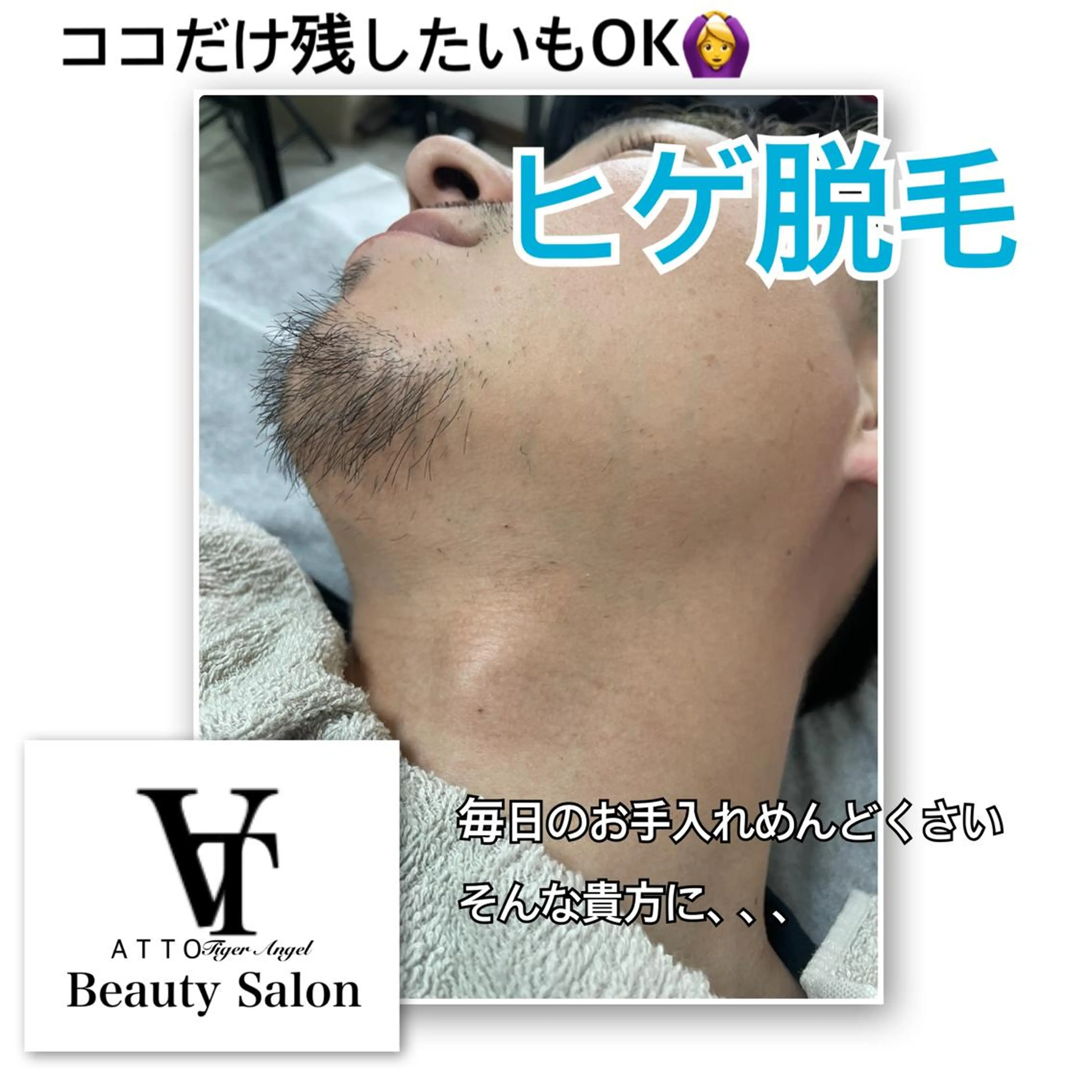 【メンズ初回限定】まずは効果を実感してください！ヒゲ脱毛🧔🧔‍♂️の写真
