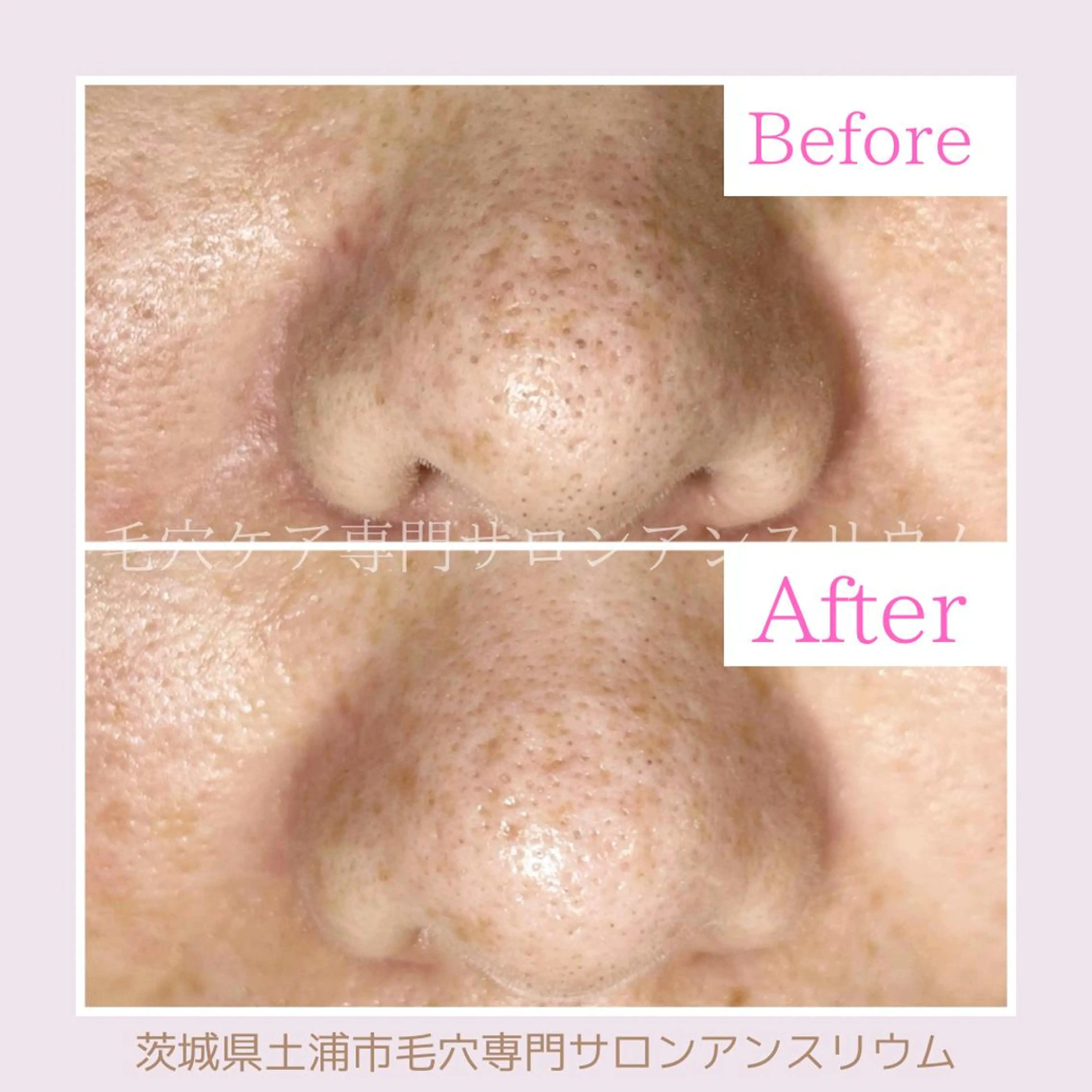 毛穴ケア専門サロンアンスリウム所属・茨城土浦 つくば毛穴 ケア専門サロンのエステ・リラクイメージ