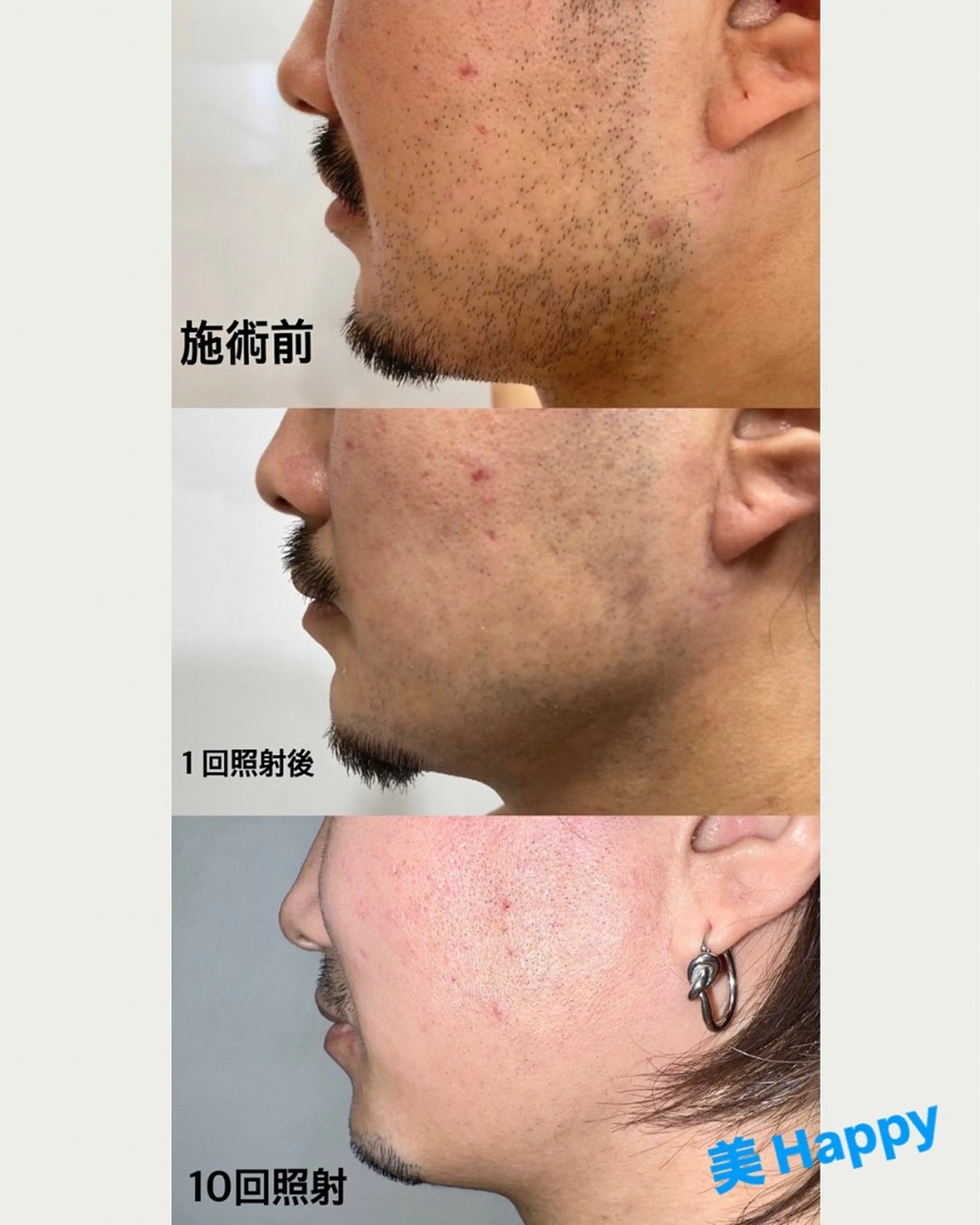 メンズ髭脱毛の写真