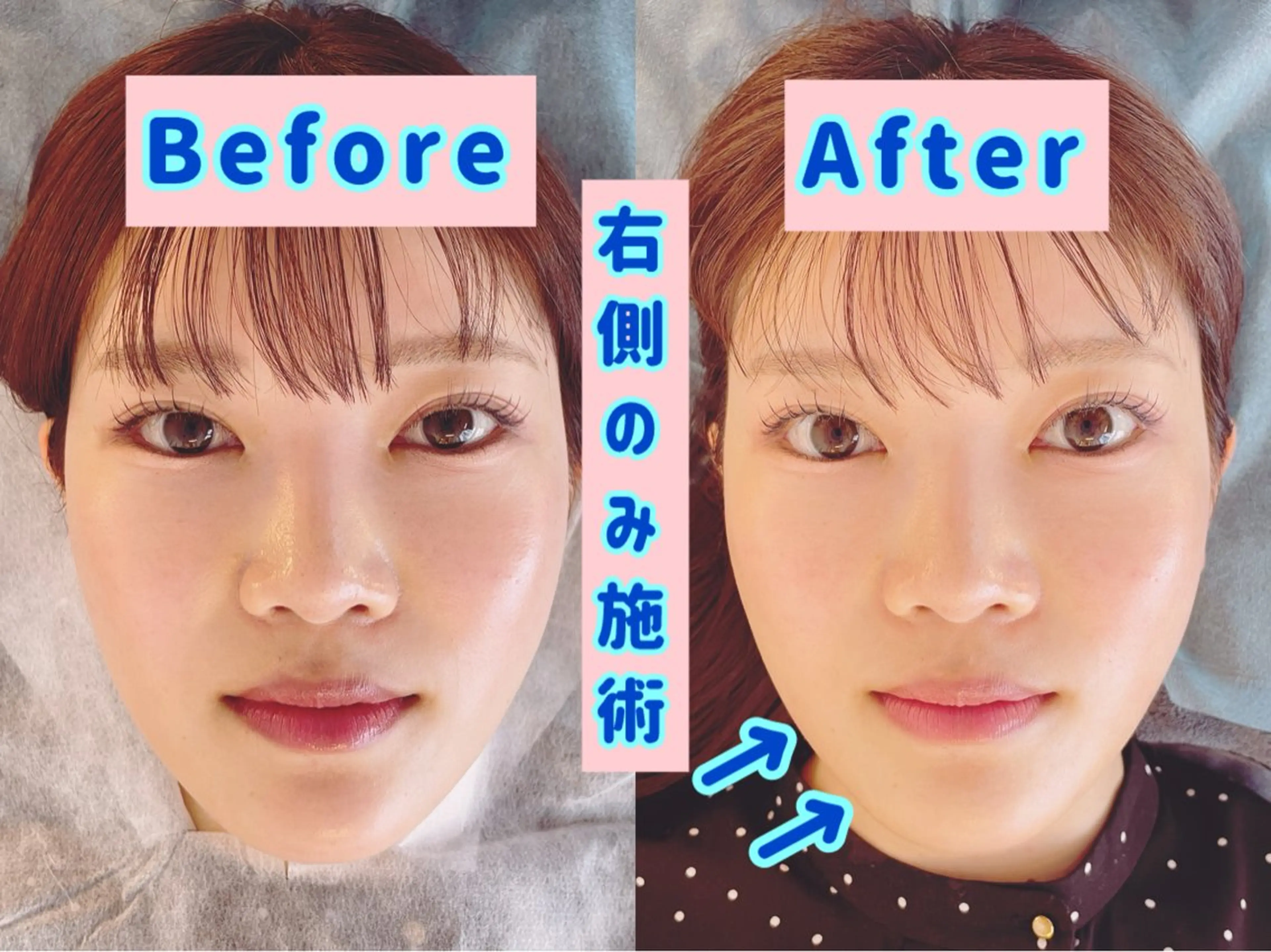 🔹ＥラインEMS美容鍼🔹業務レベルのEMSで360°美しい小顔に変身✨の写真