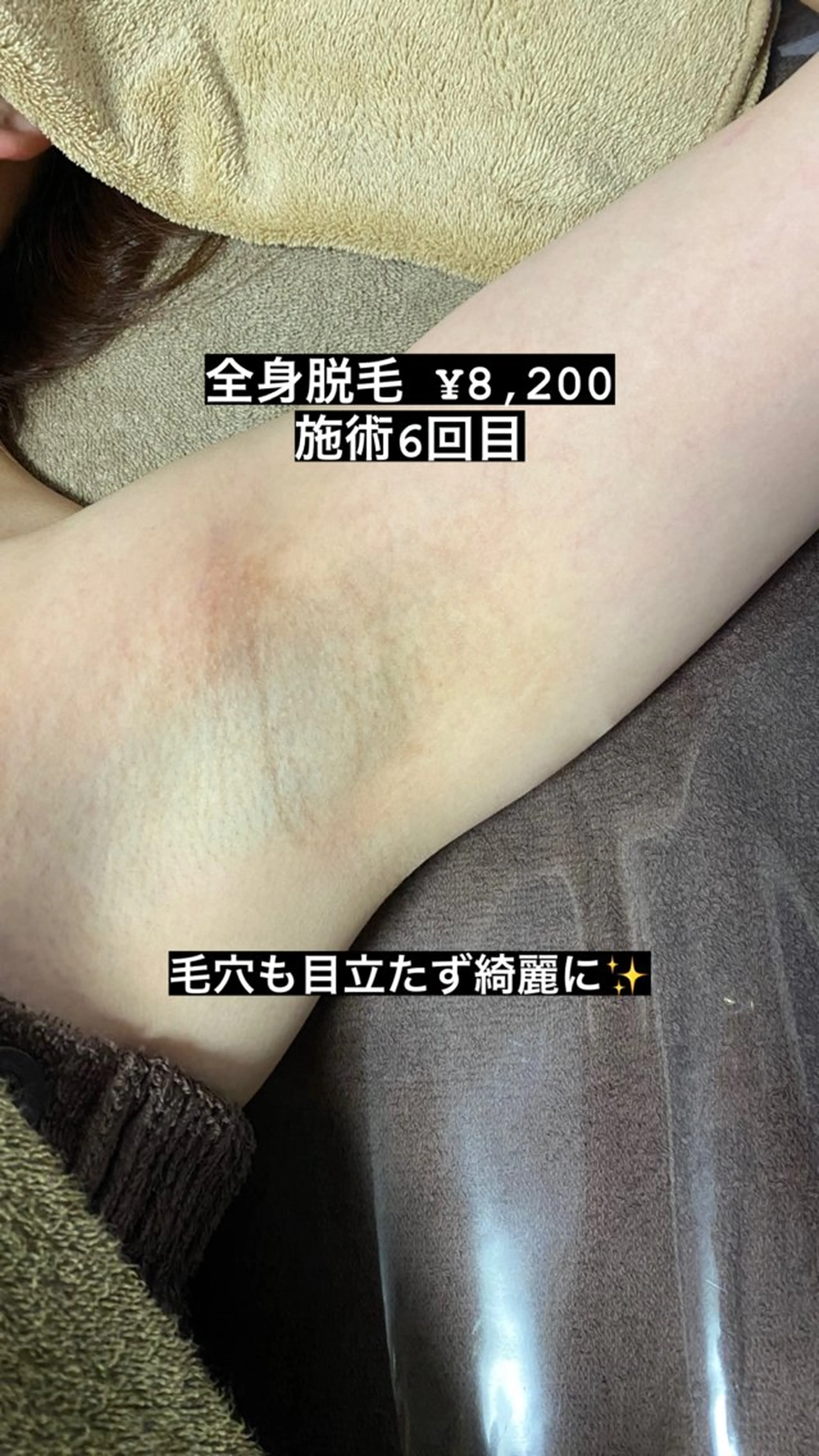 脱毛 lol's所属・lol's na2のネイルデザイン