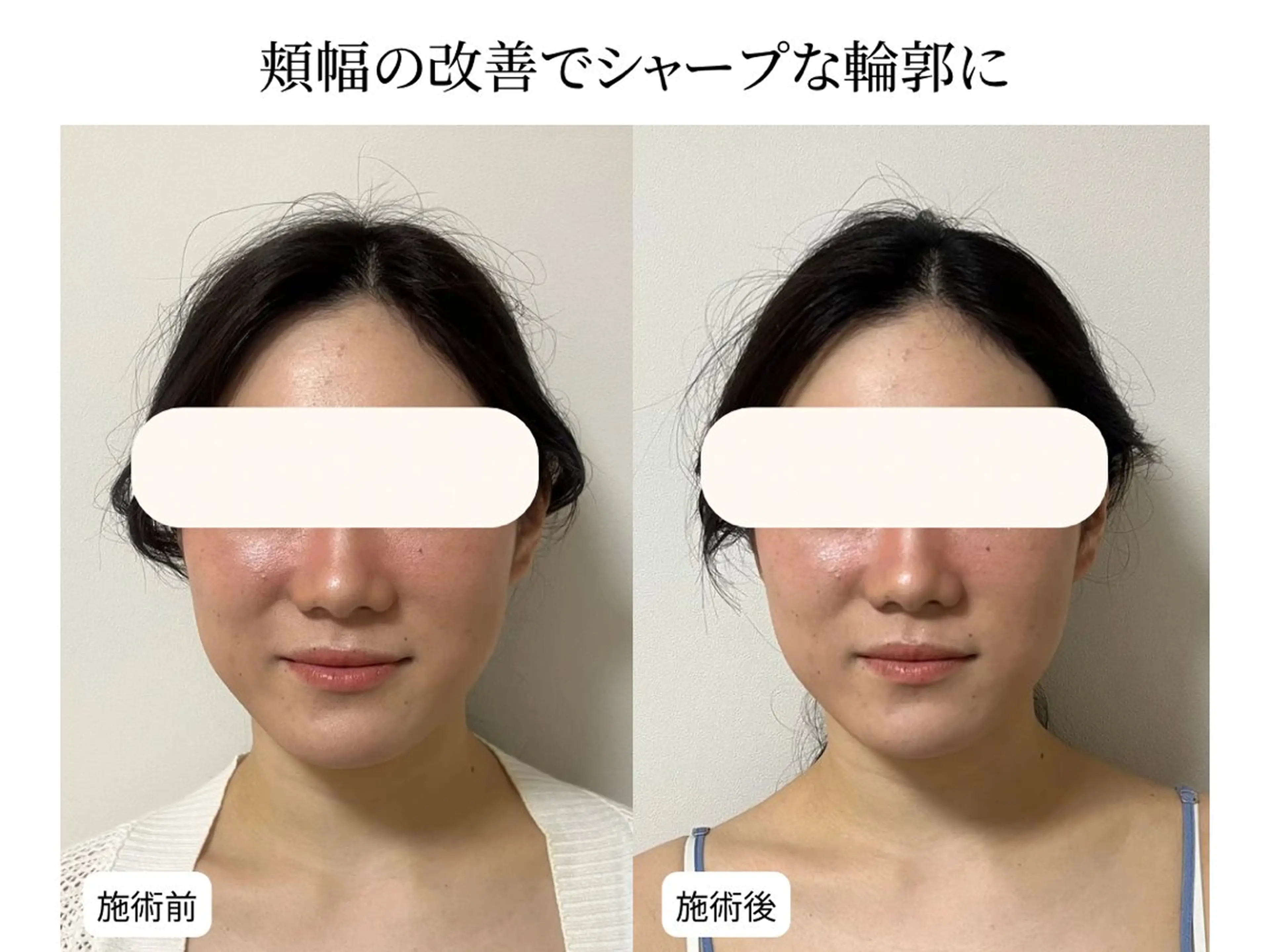 【たるみ・ほうれい線改善】小顔整体＋4D小顔矯正＋姿勢矯正　12000円→の写真