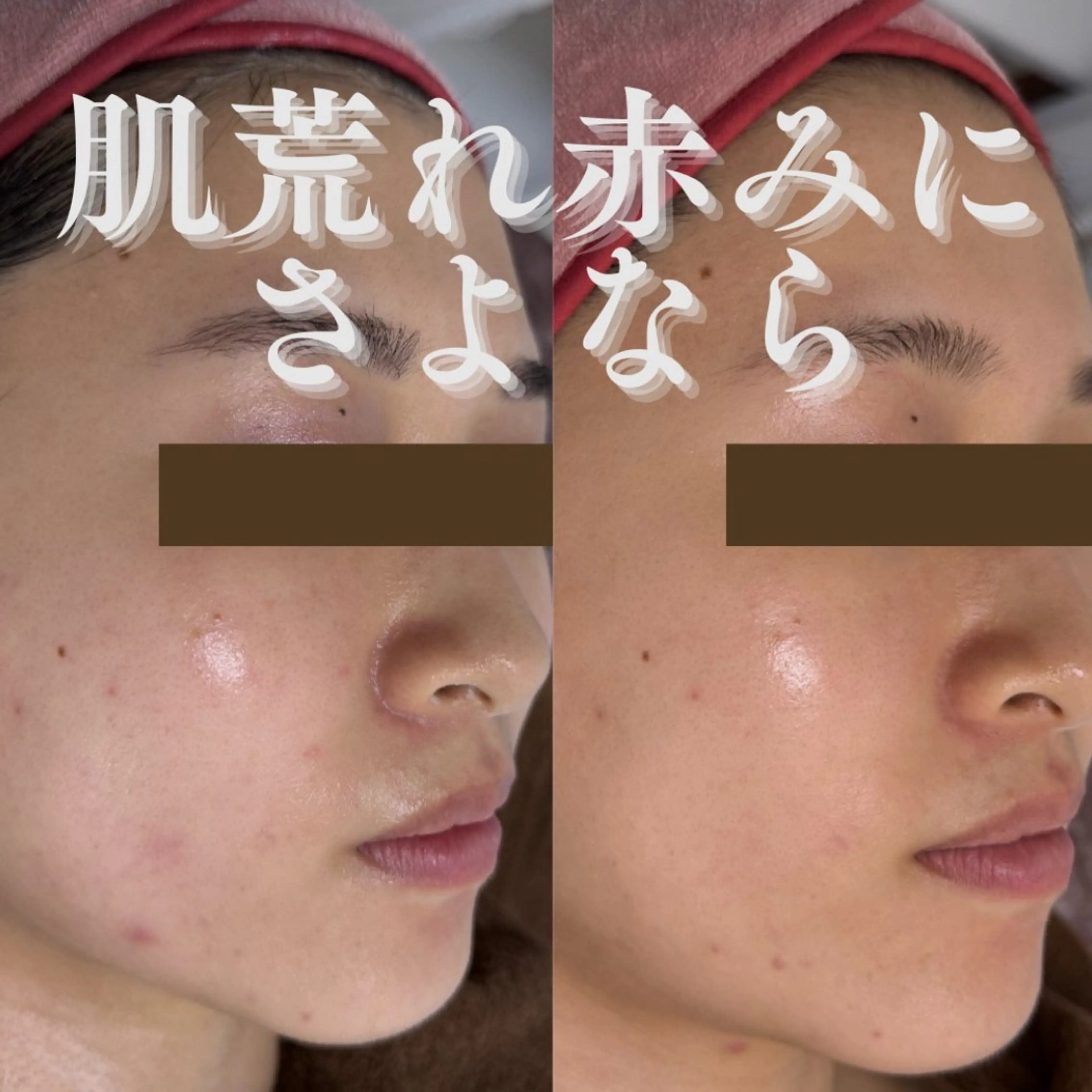 エステ 肌質改善×毛穴洗浄 ナスサロ 看護師只野のエステ・リラクイメージ