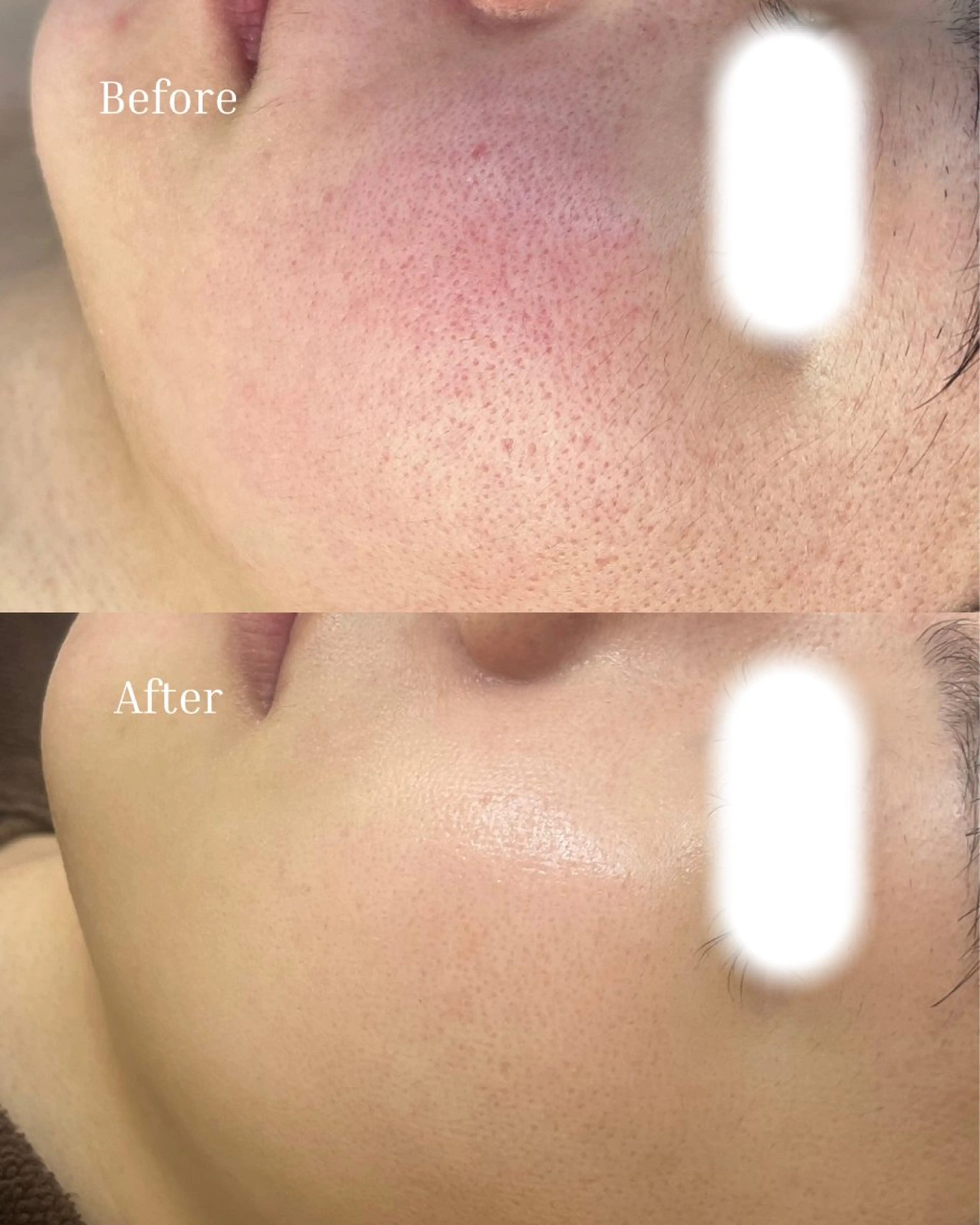 エステ BELLIS HUIT所属・体質｜肌質改善ꕤ BELLISHUITのその他イメージ