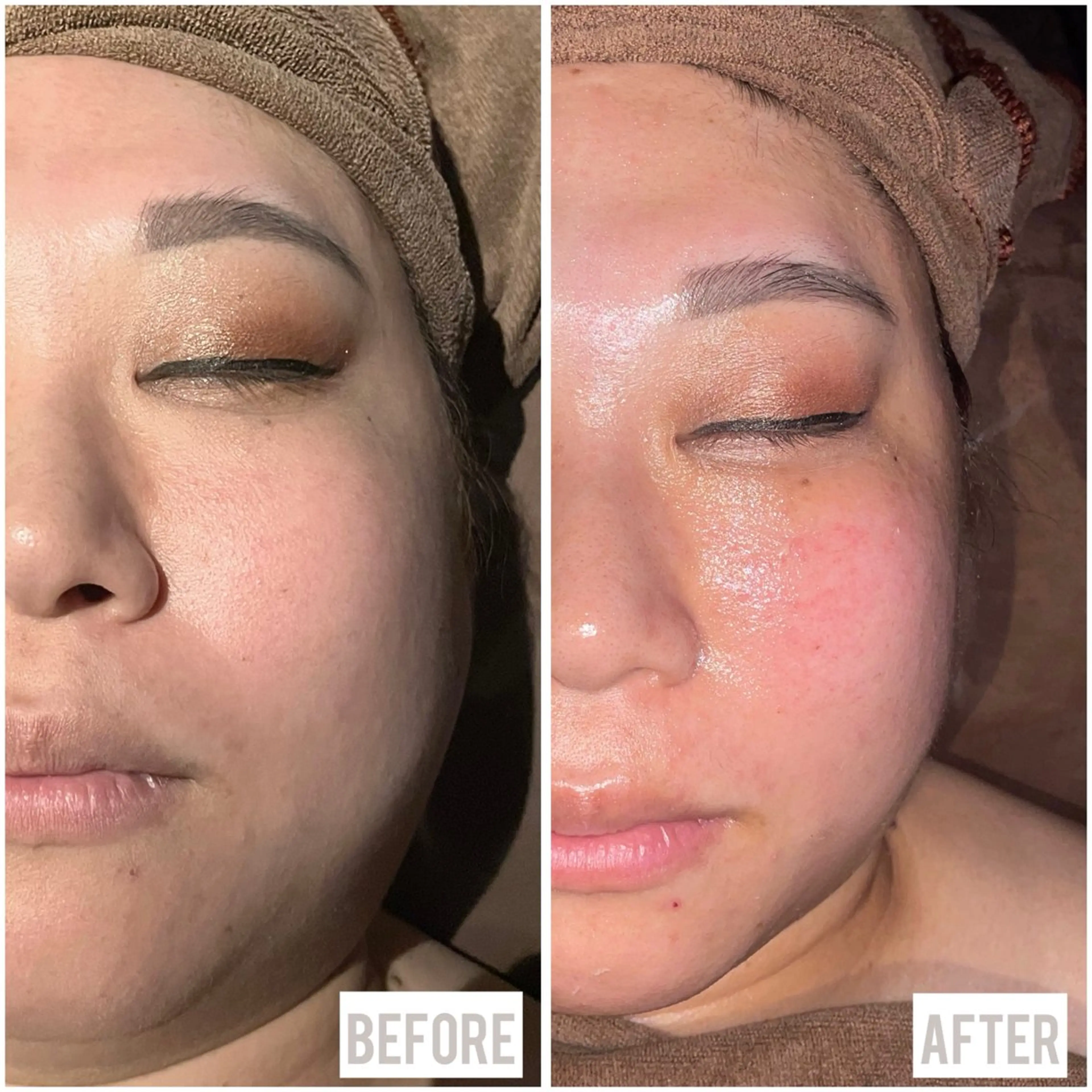 🌟【練習モデル募集】ぽにょ取り💆‍♀️ ラジオ波でスッキリ小顔✨《痛みなし・ダウンタイムなし・エイジングケア》の写真