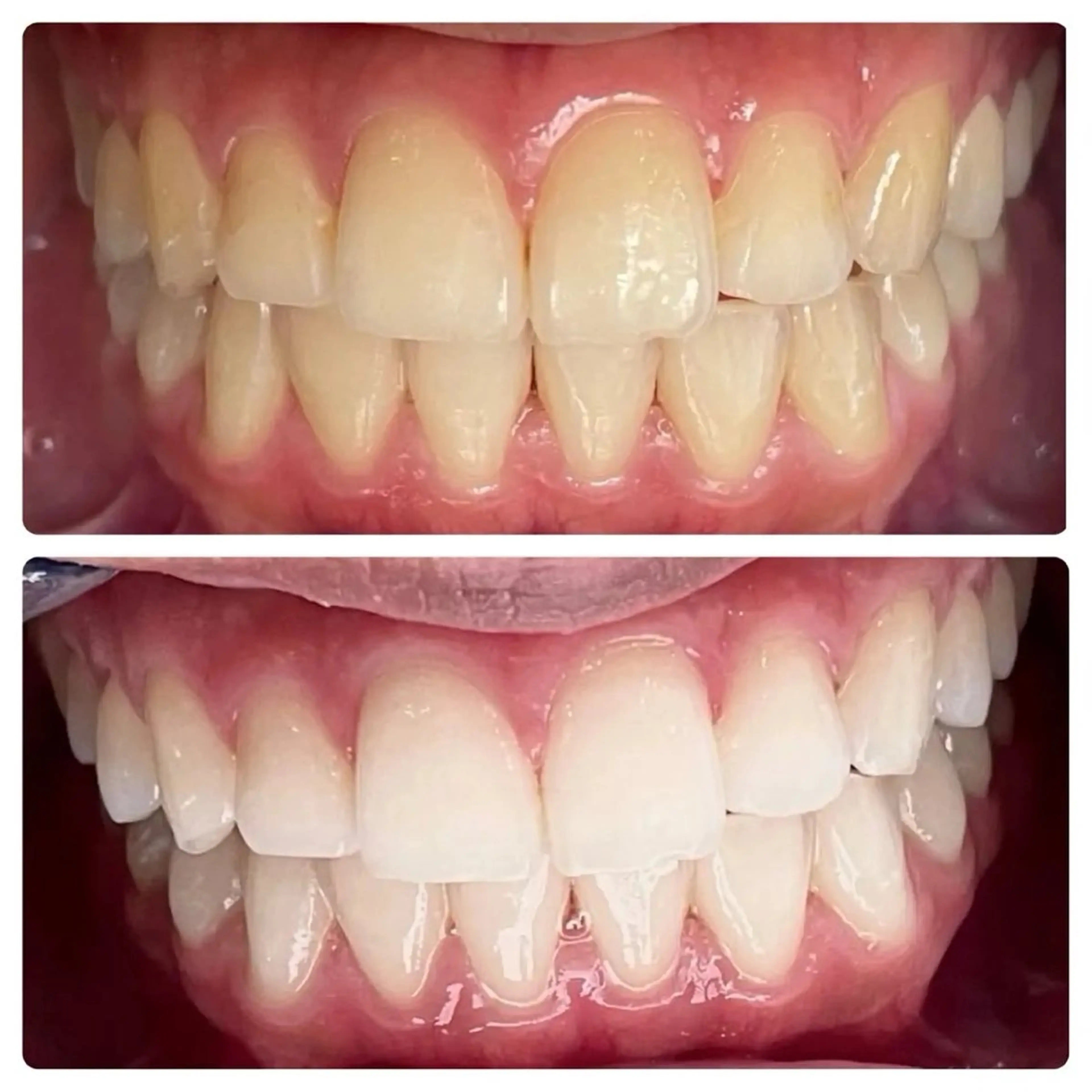 【当日限定】歯の黄ばみにセルフホワイトニング体験メニュー🦷8分×3回で効果実感🩵セルフで簡単本格ケア✨駅チカの写真