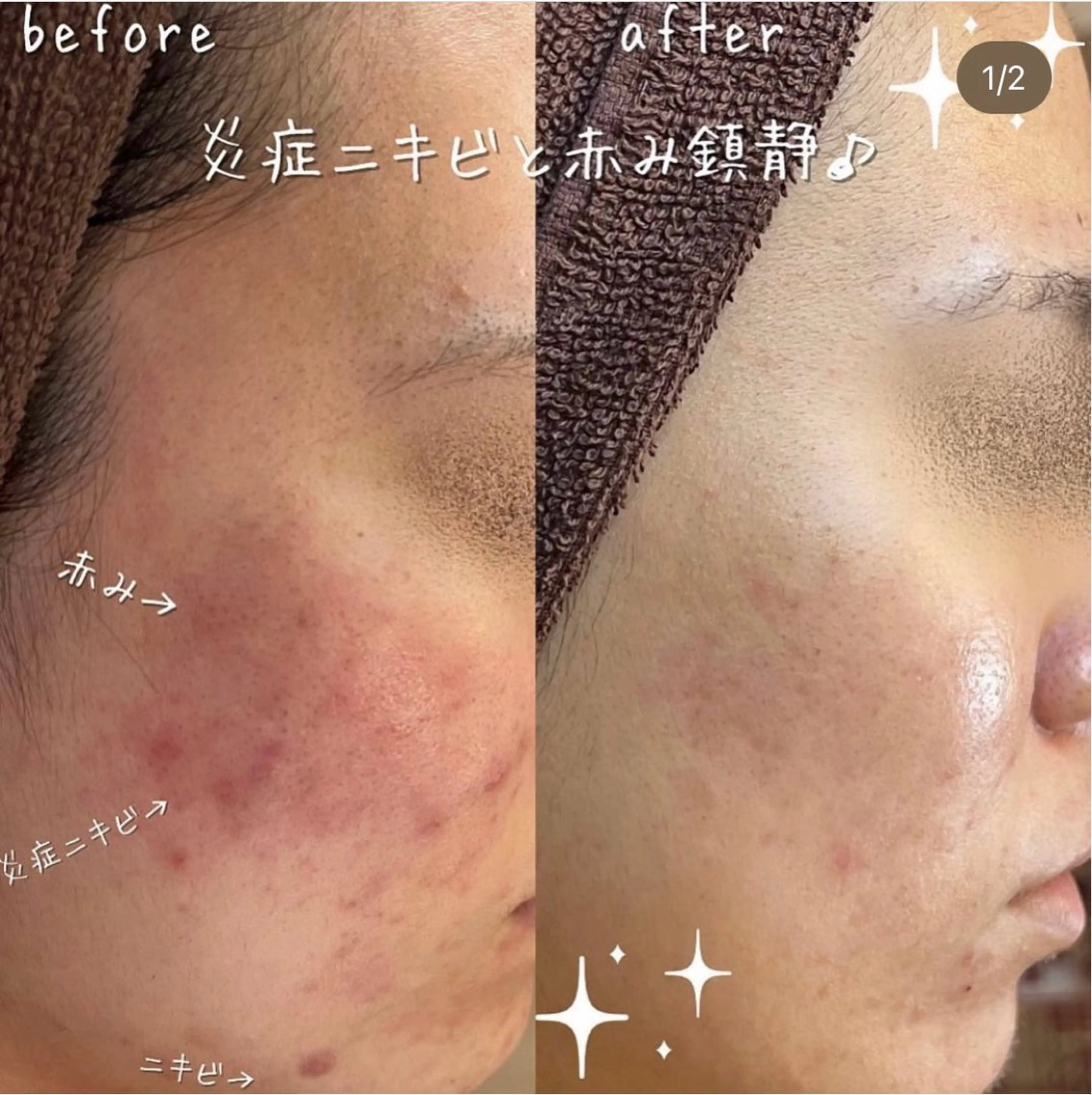 エステ 【ハーブピーリング/毛穴洗浄】NA skin 川崎店〜ニキビ・毛穴専門店〜所属・NAskin川崎 皆川のエステ・リラクイメージ