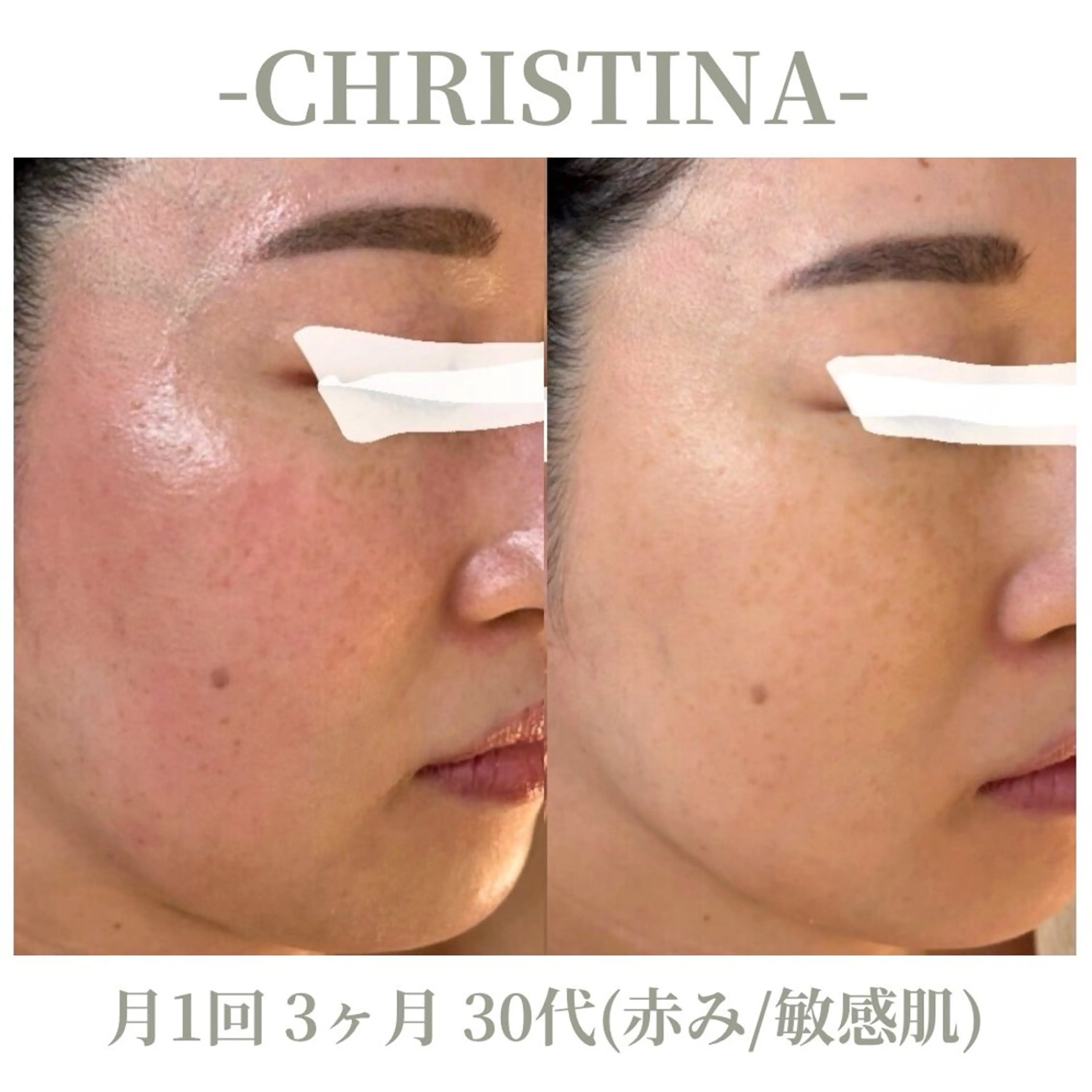 エステ 肌質改善|天王寺 For...はるかのエステ・リラクイメージ