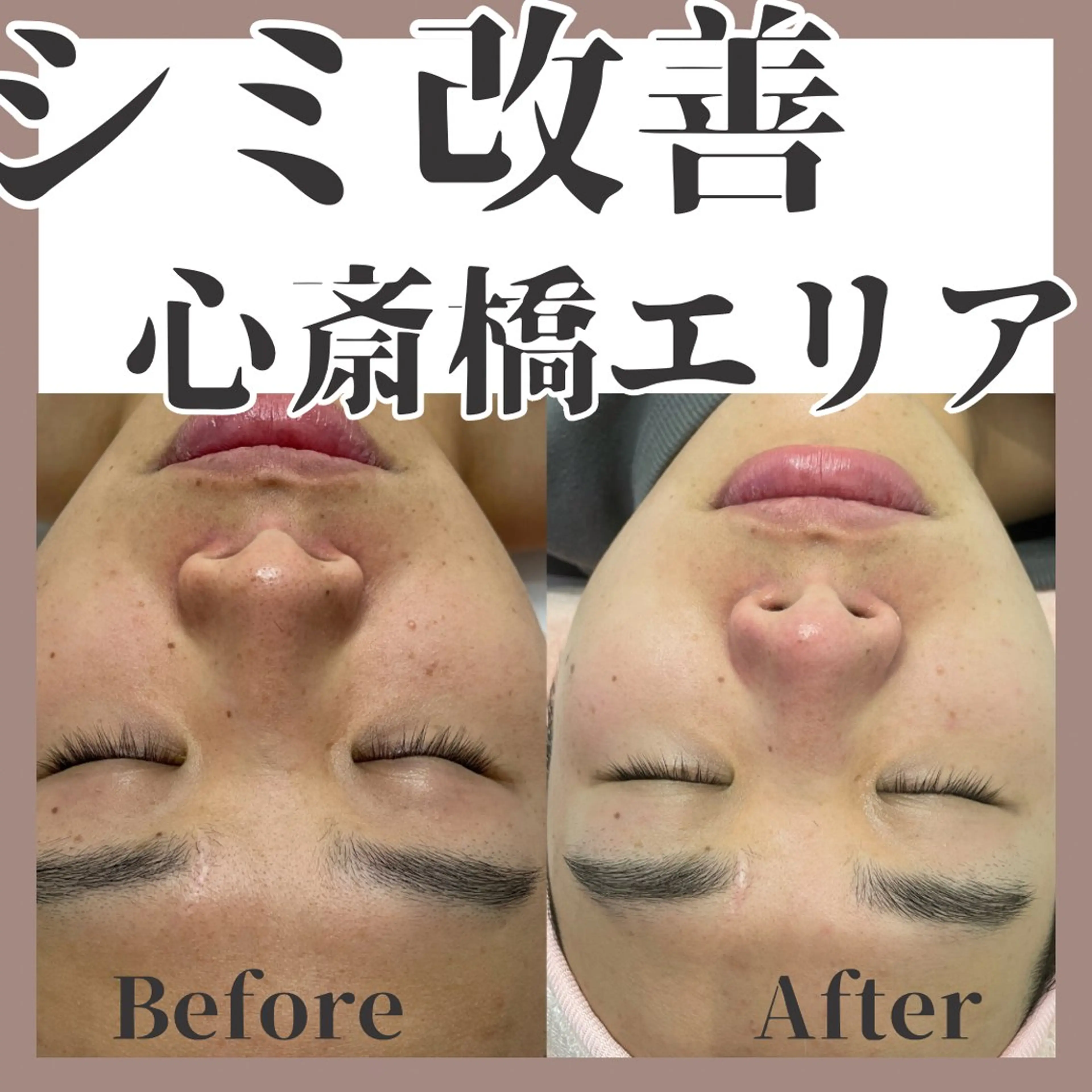 【 シミ / 美顔 】肌質改善IPLフォト🦋の写真