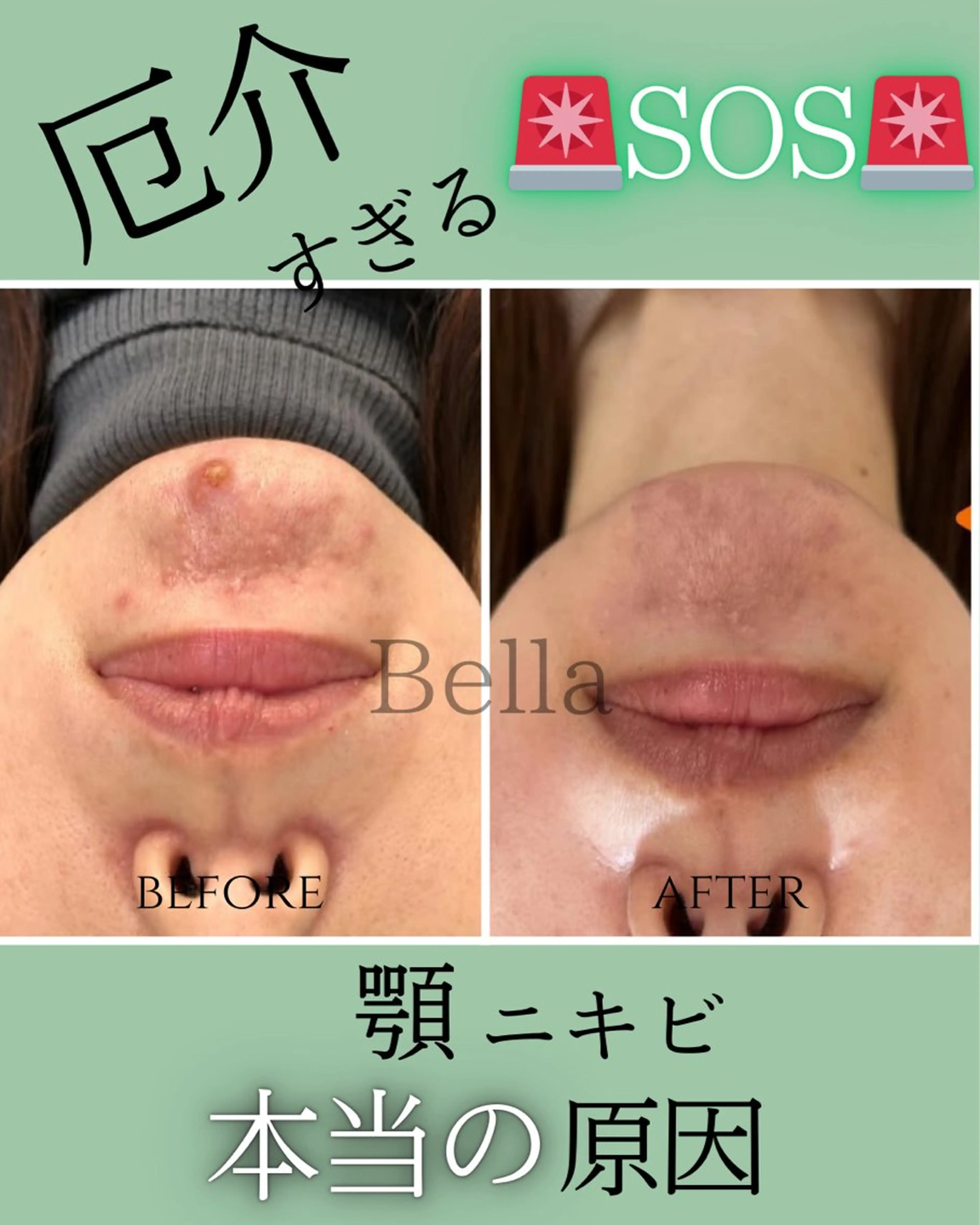 【ダウンタイム無し】敏感肌OK✨しっとり透明感UPハーブピーリング剥離なしの写真