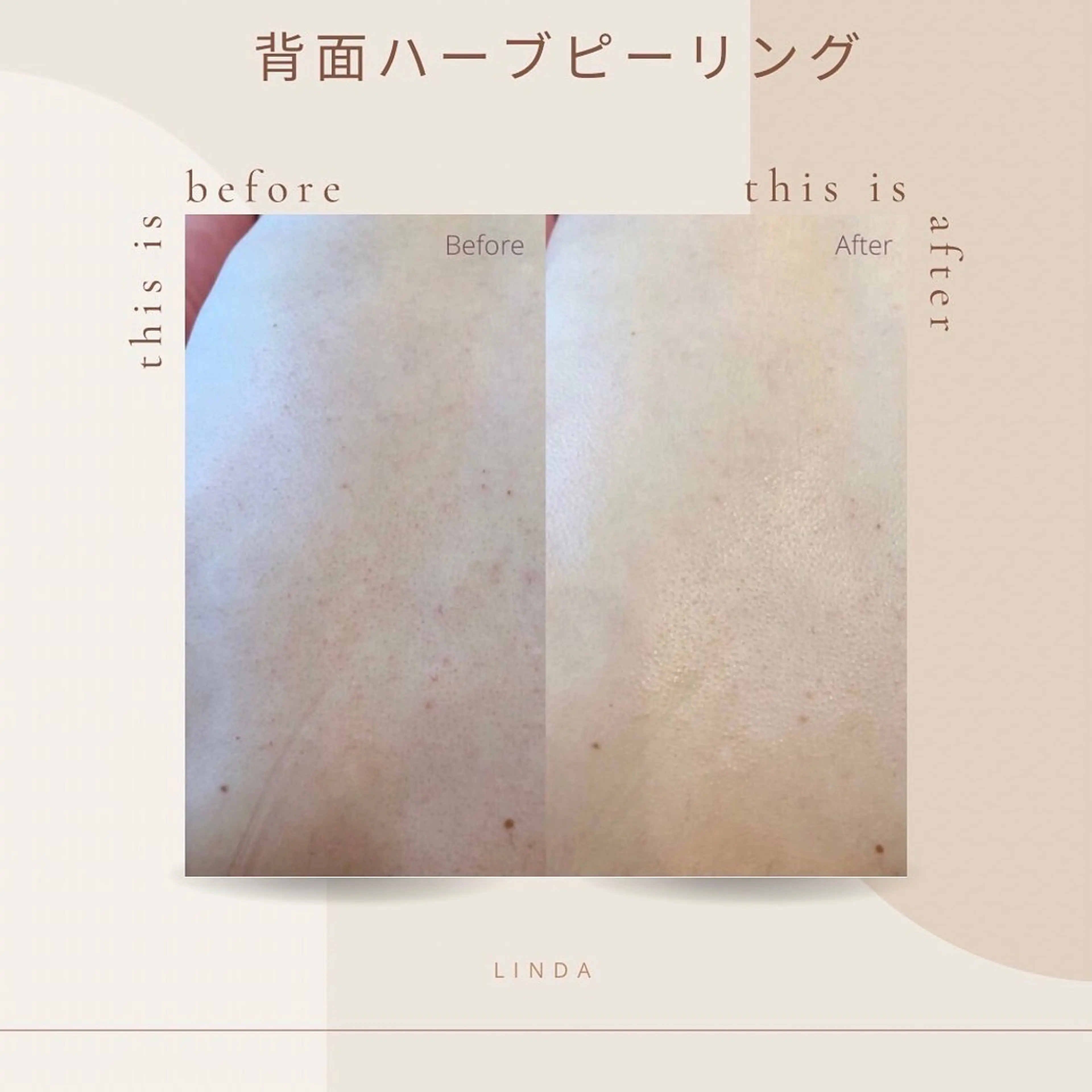 【ニキビケアでつるつる美背中】背中　剥離なしハーブピーリングの写真