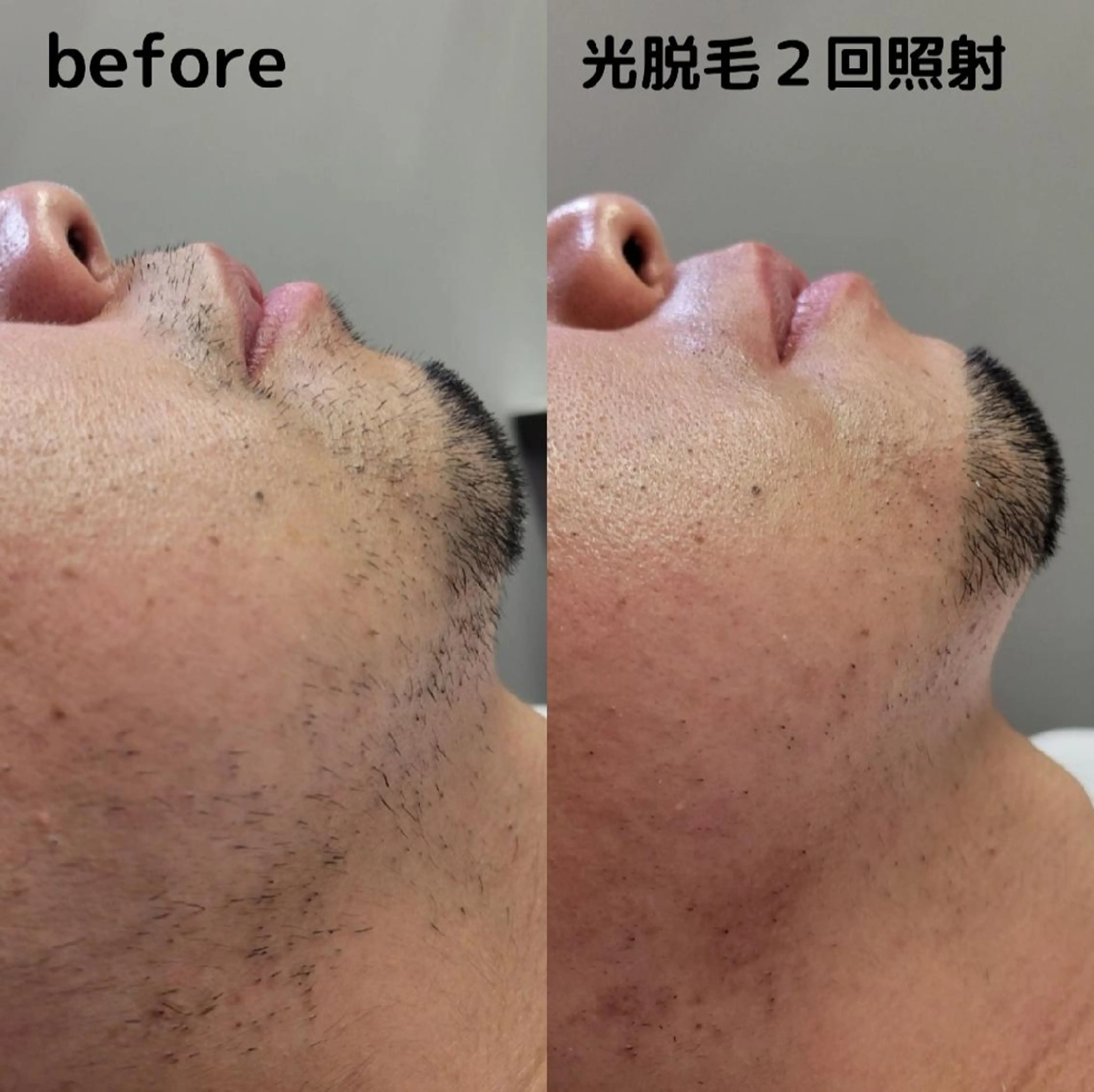 【都度払いOK🙆‍♀️】メンズ髭脱毛 /デザイン可の写真