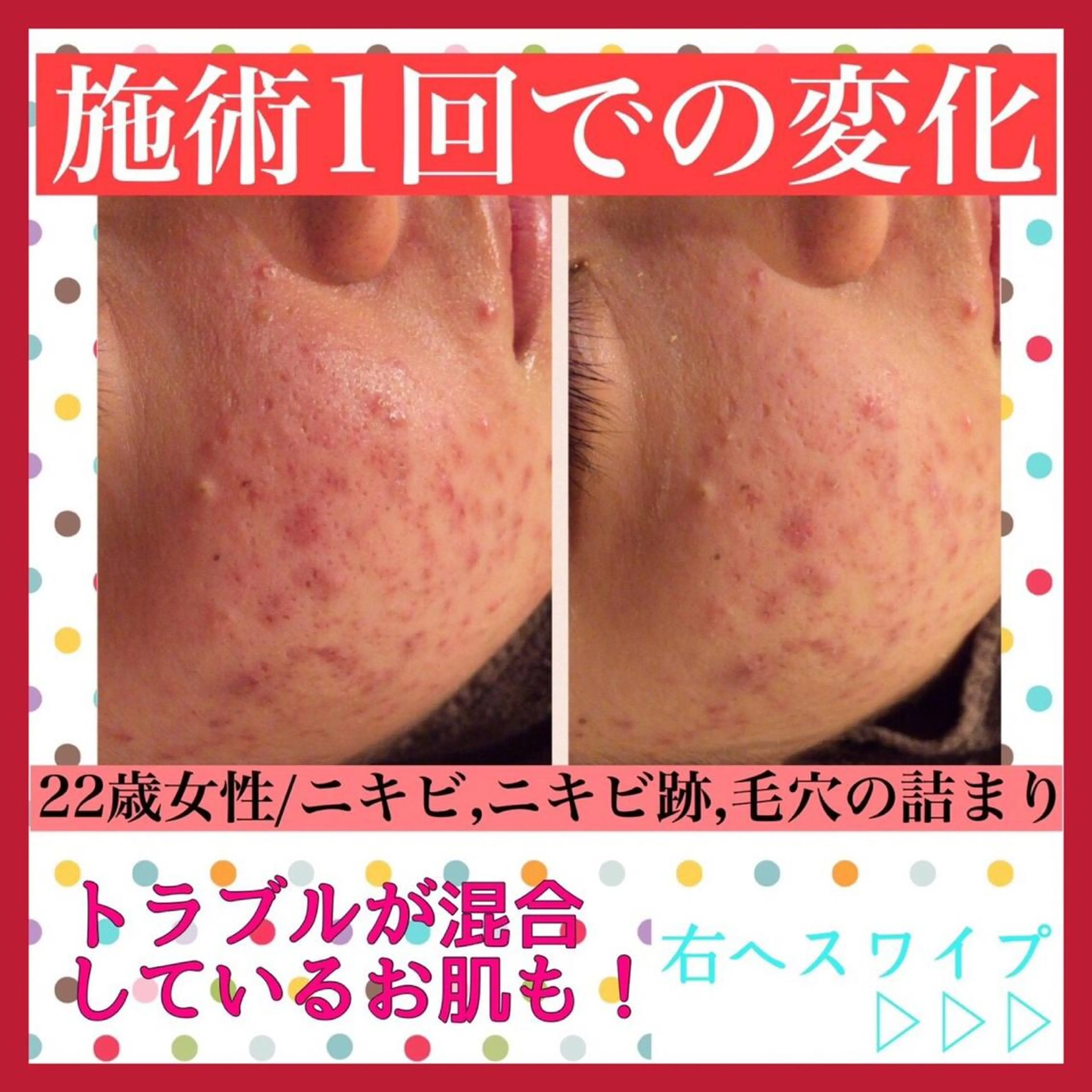 ミディアム カラー パーマ ヘアアレンジ メンズ キッズ ネイル マツエク・マツパ アイブロウ エステ リラク アクール　齋藤 ♡肌トラブル卒業のエステ・リラクイメージ