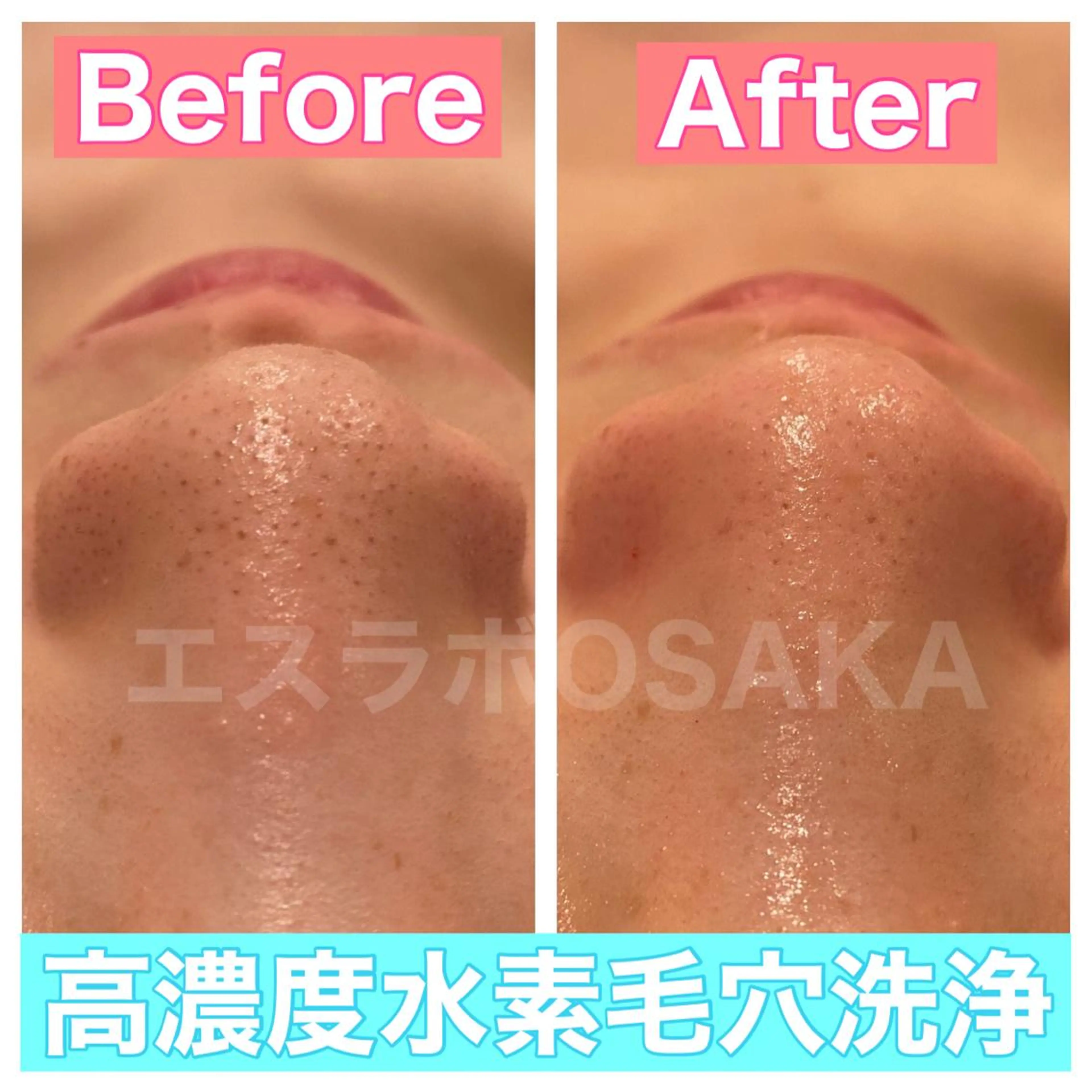 【高濃度水素毛穴洗浄】の写真