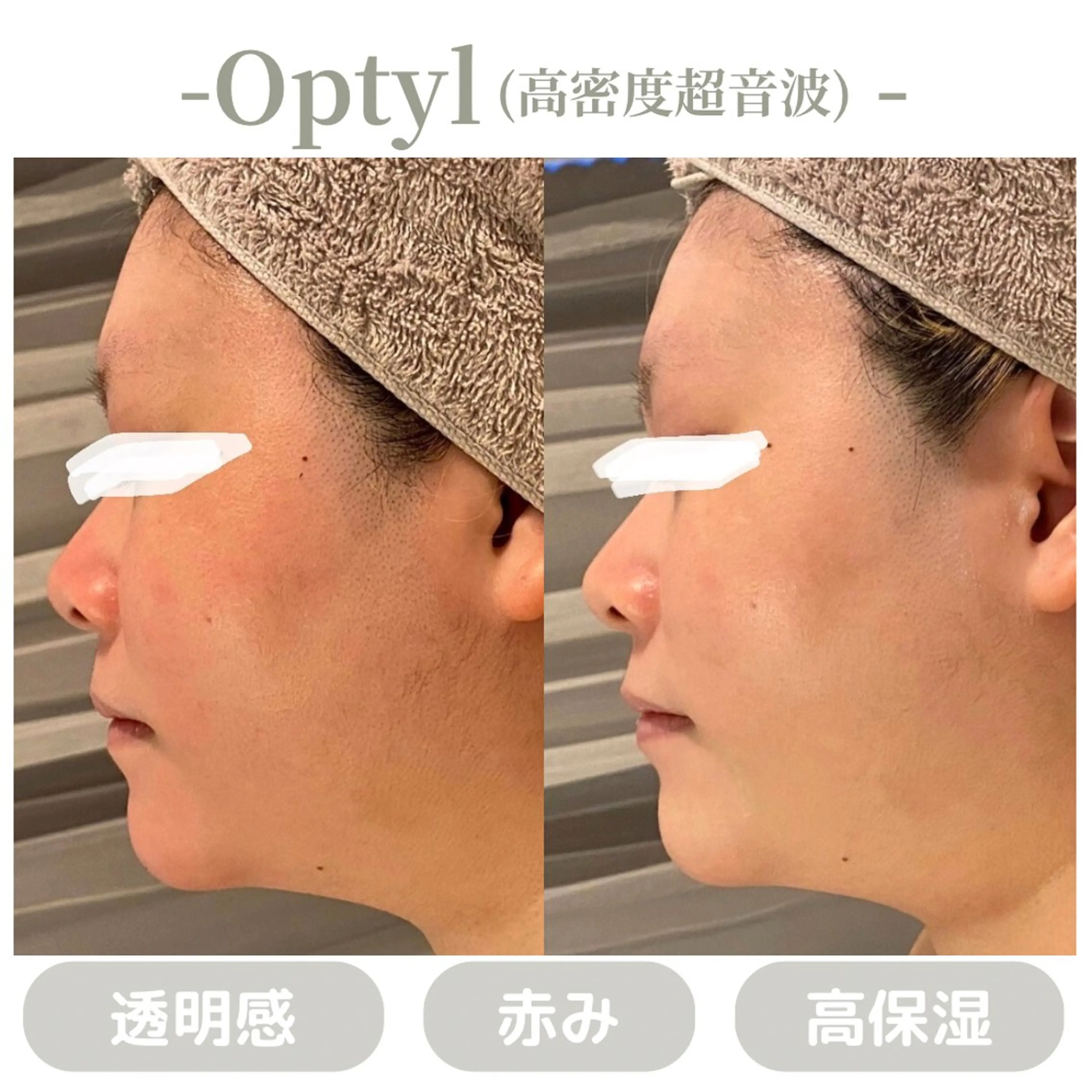 エステ 肌質改善|天王寺 For...はるかのエステ・リラクイメージ