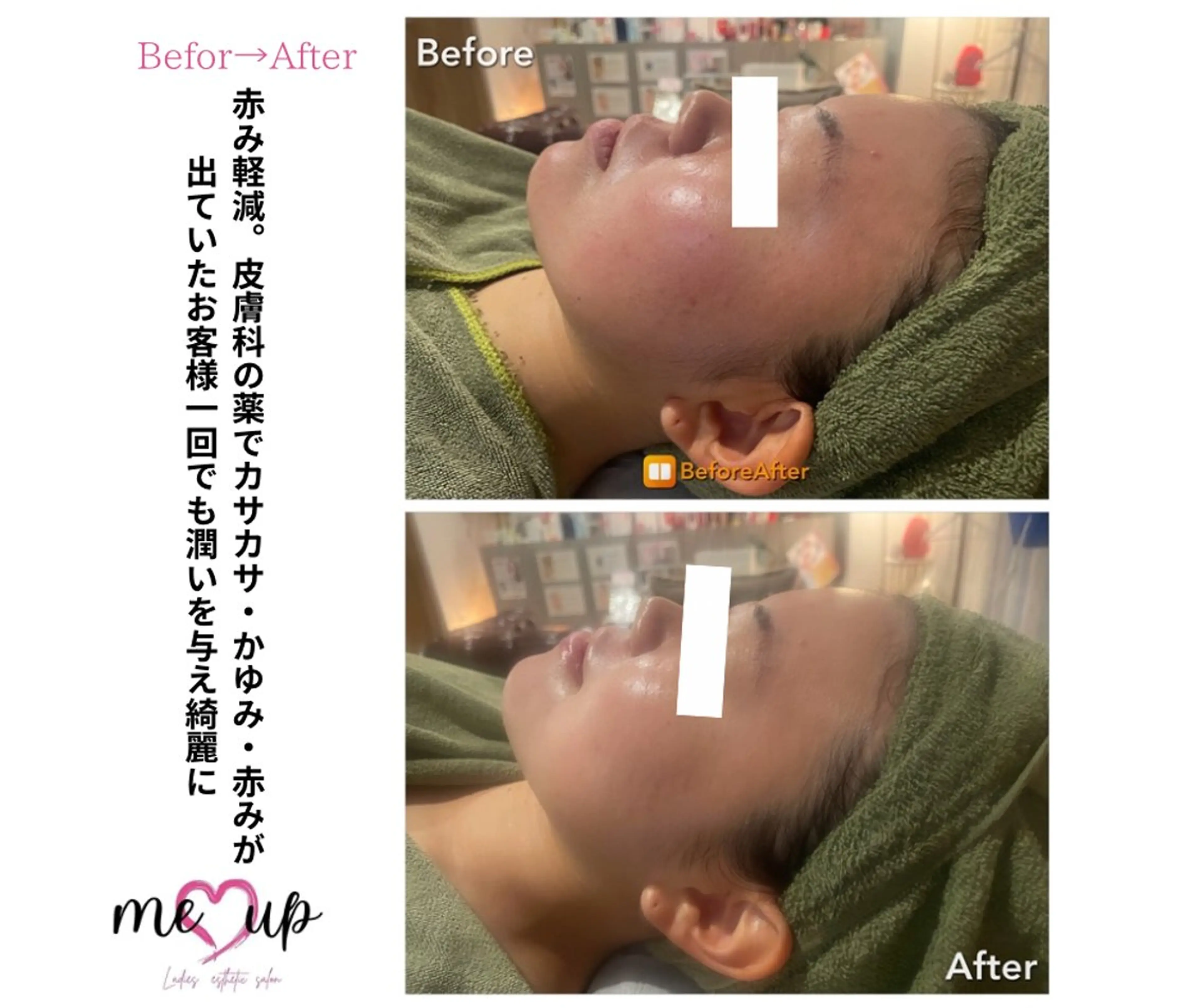 Meupニキビ専門店 背中/ハーブ/ララのその他イメージ