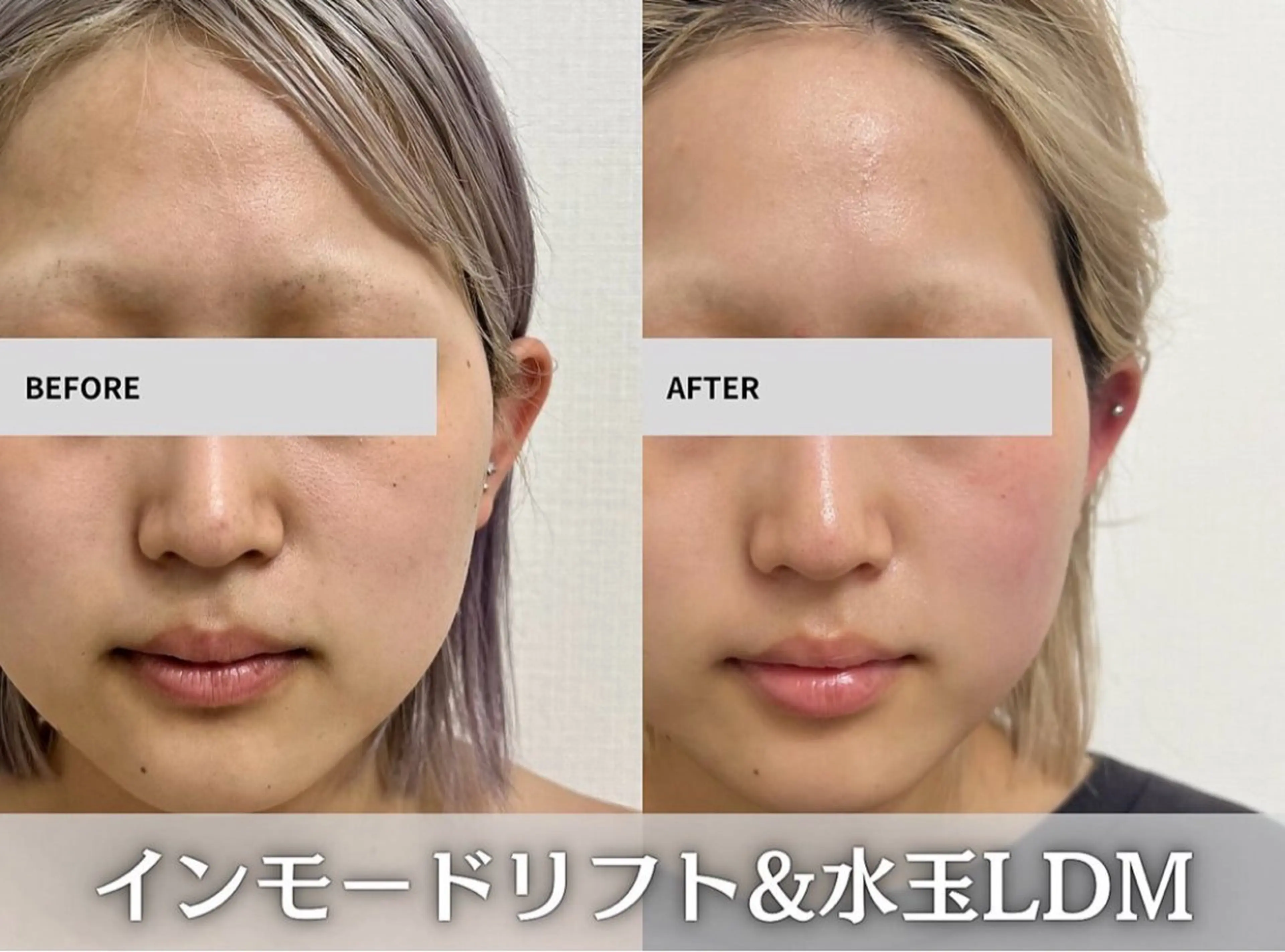 インモード×水玉LDM🫧 2点の写真