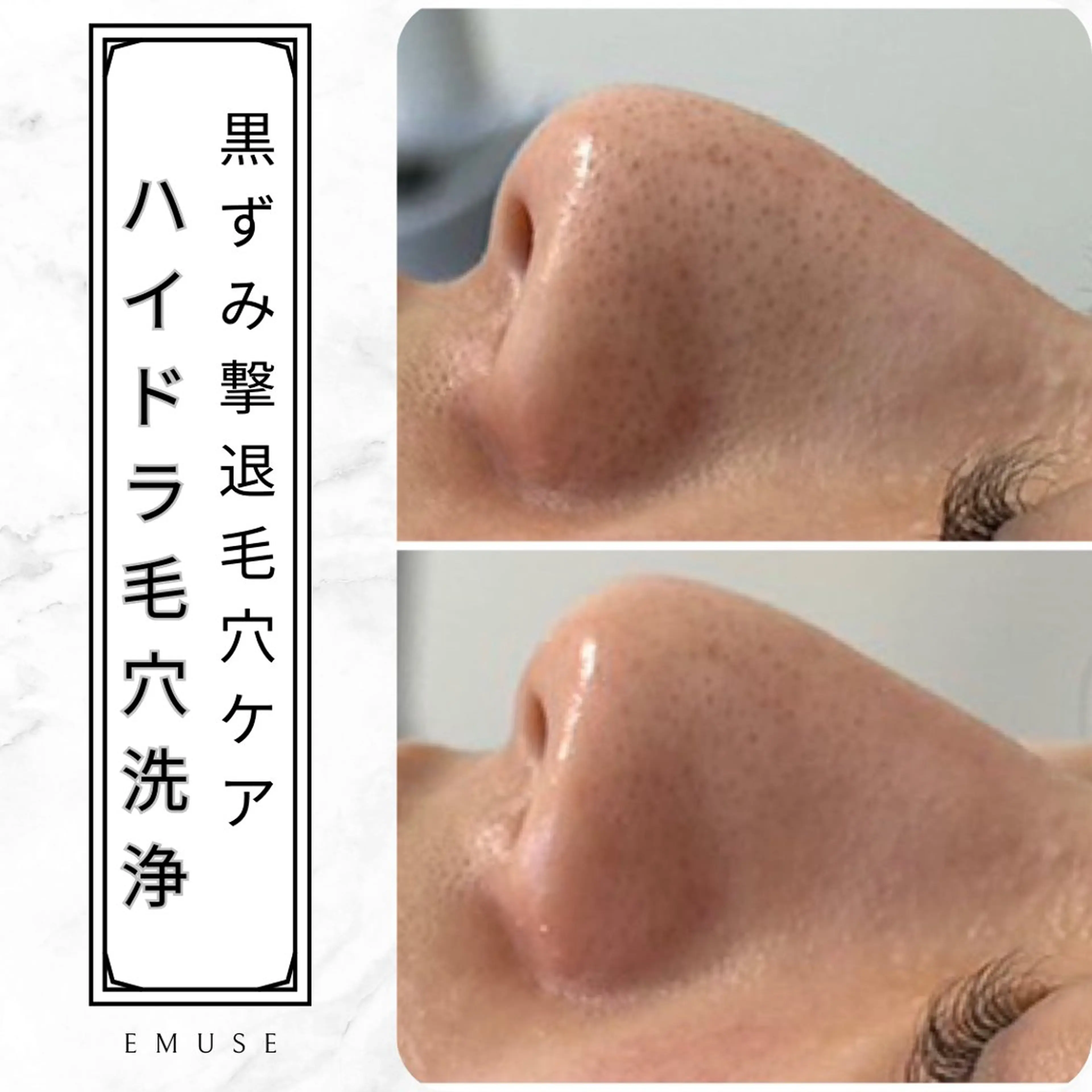 黒ずみざらつき撃退毛穴ケア！お試し毛穴洗浄コースの写真