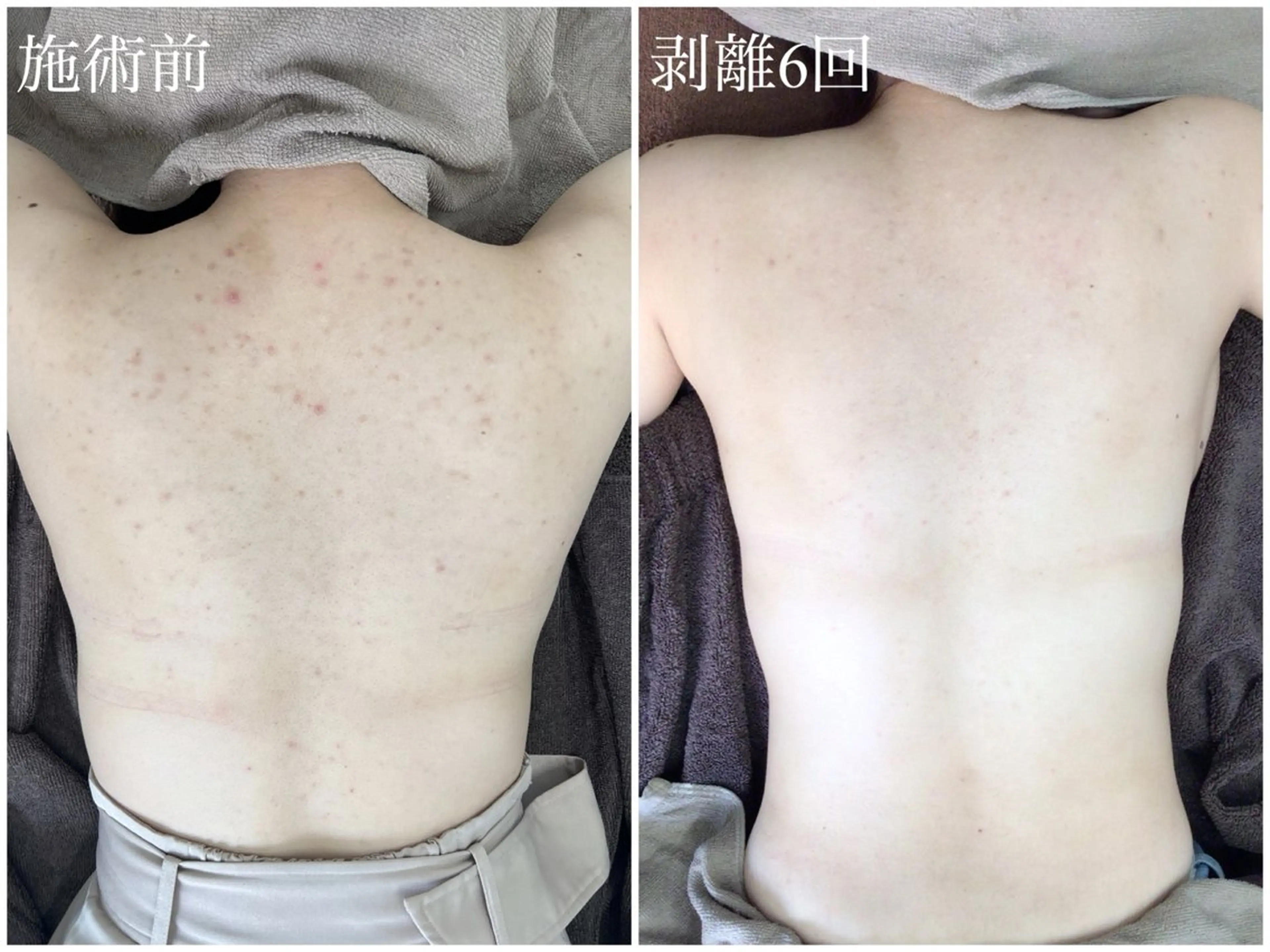 【背中ハーブピーリング】ニキビにアプローチ★艶肌背中コース※Google口コミ必須の写真