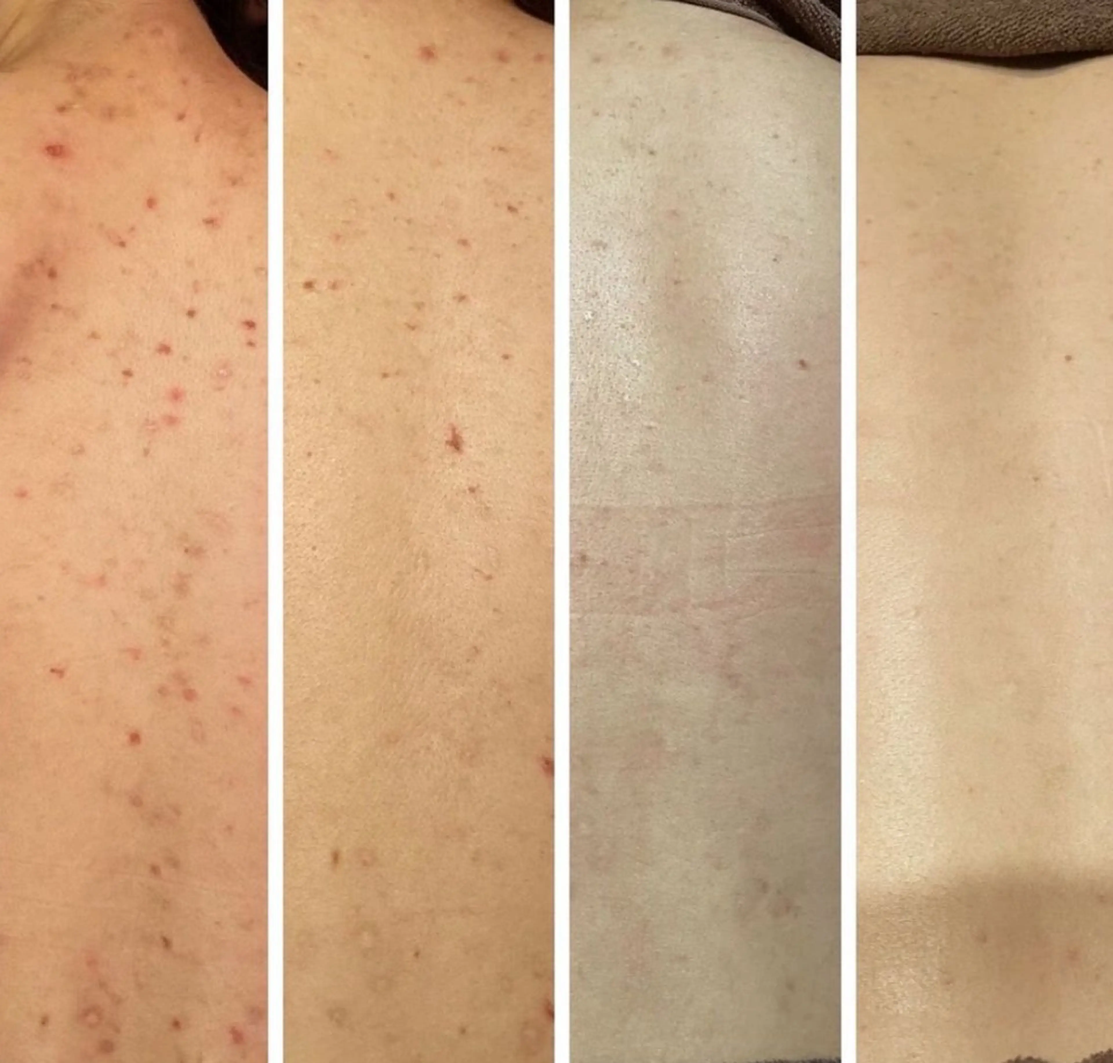 ハーブピーリング🌿その他の箇所の写真