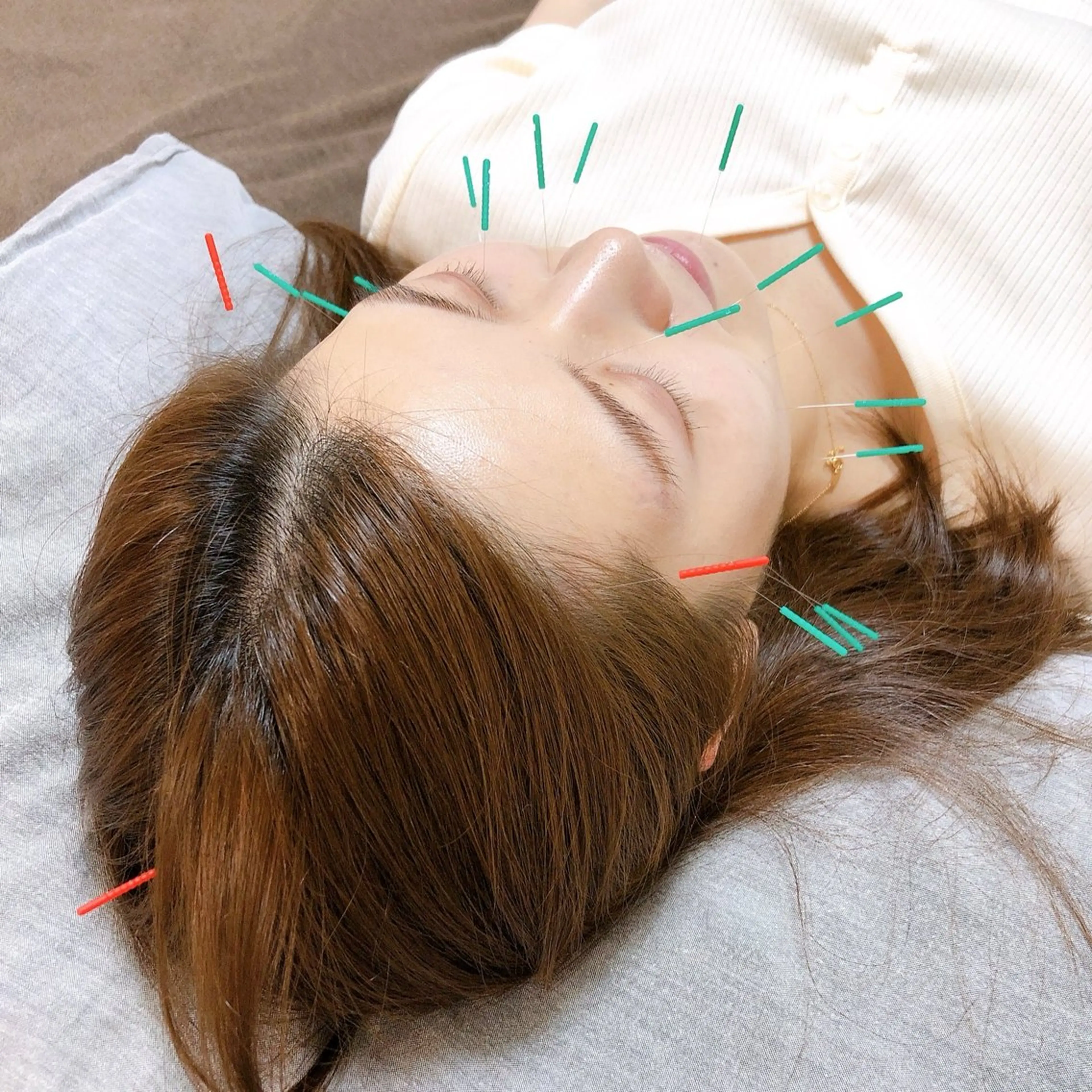 お顔の美容鍼灸の写真