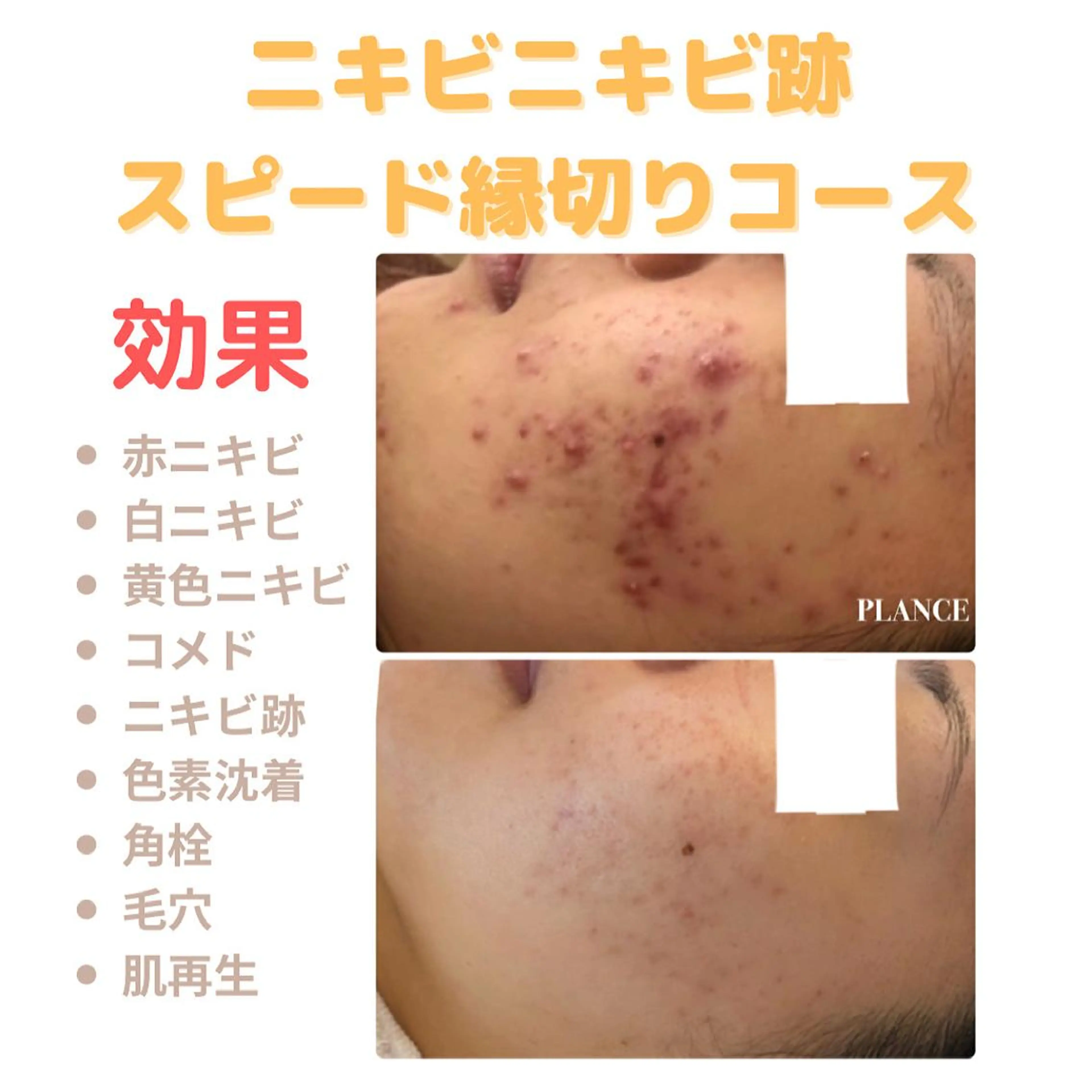 エステ フェイシャル専門 肌質改善/プランスのエステ・リラクイメージ