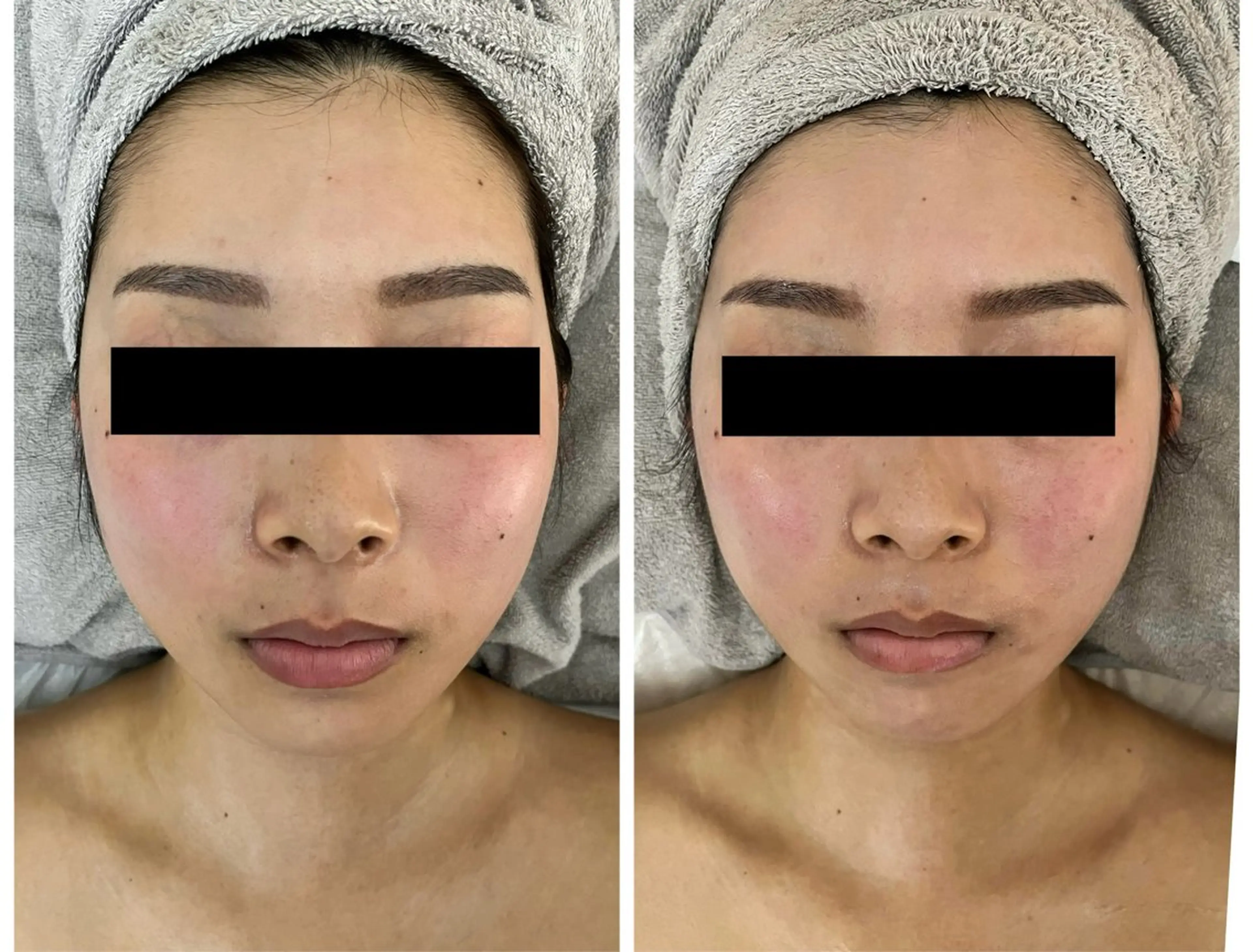 【自分史上1番の小顔に】彼に気付かれる! 即実感小顔体験(施術60分)22000→9900の写真