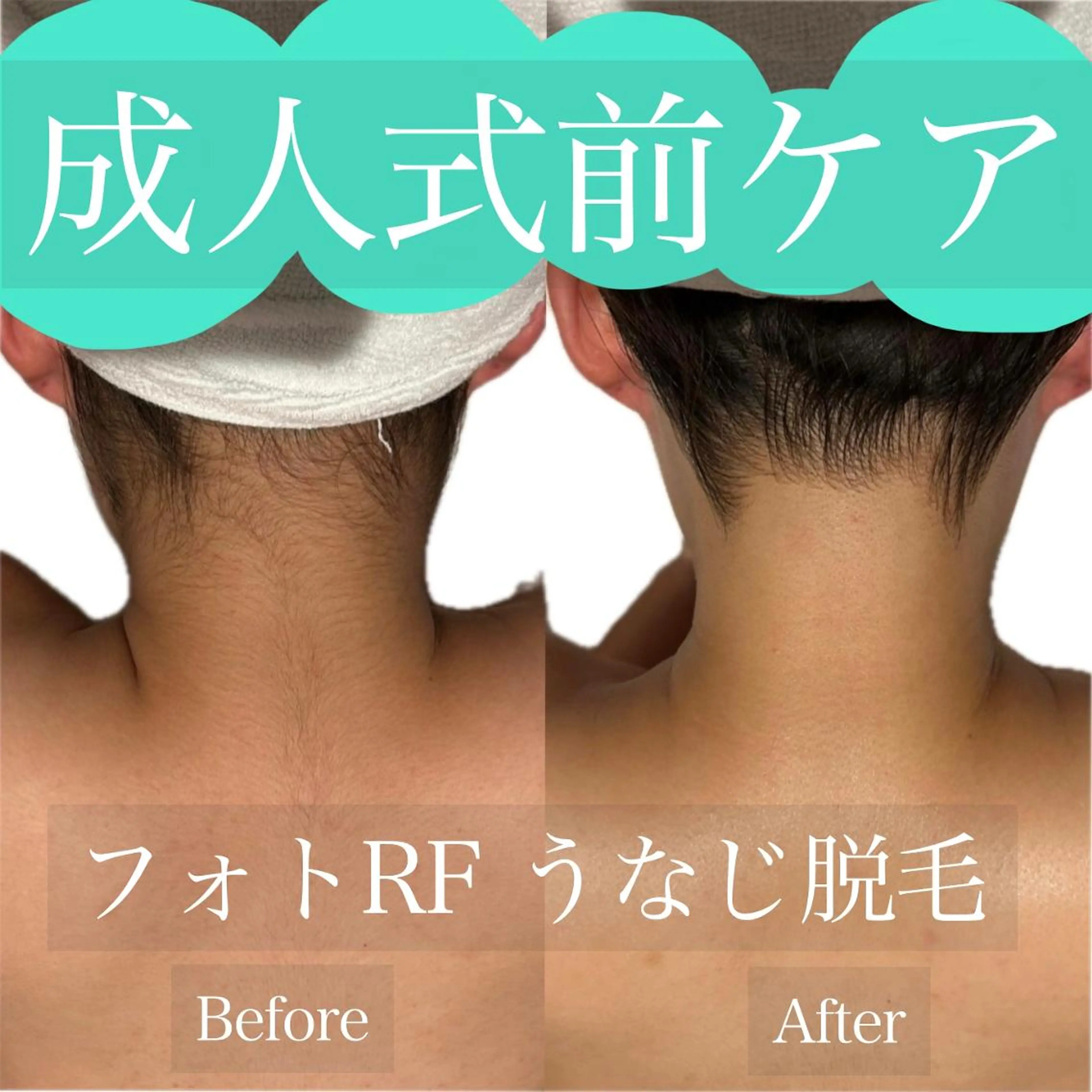 【成人式前ケア☆】 フォトRF うなじ脱毛 ¥2,980✨の写真