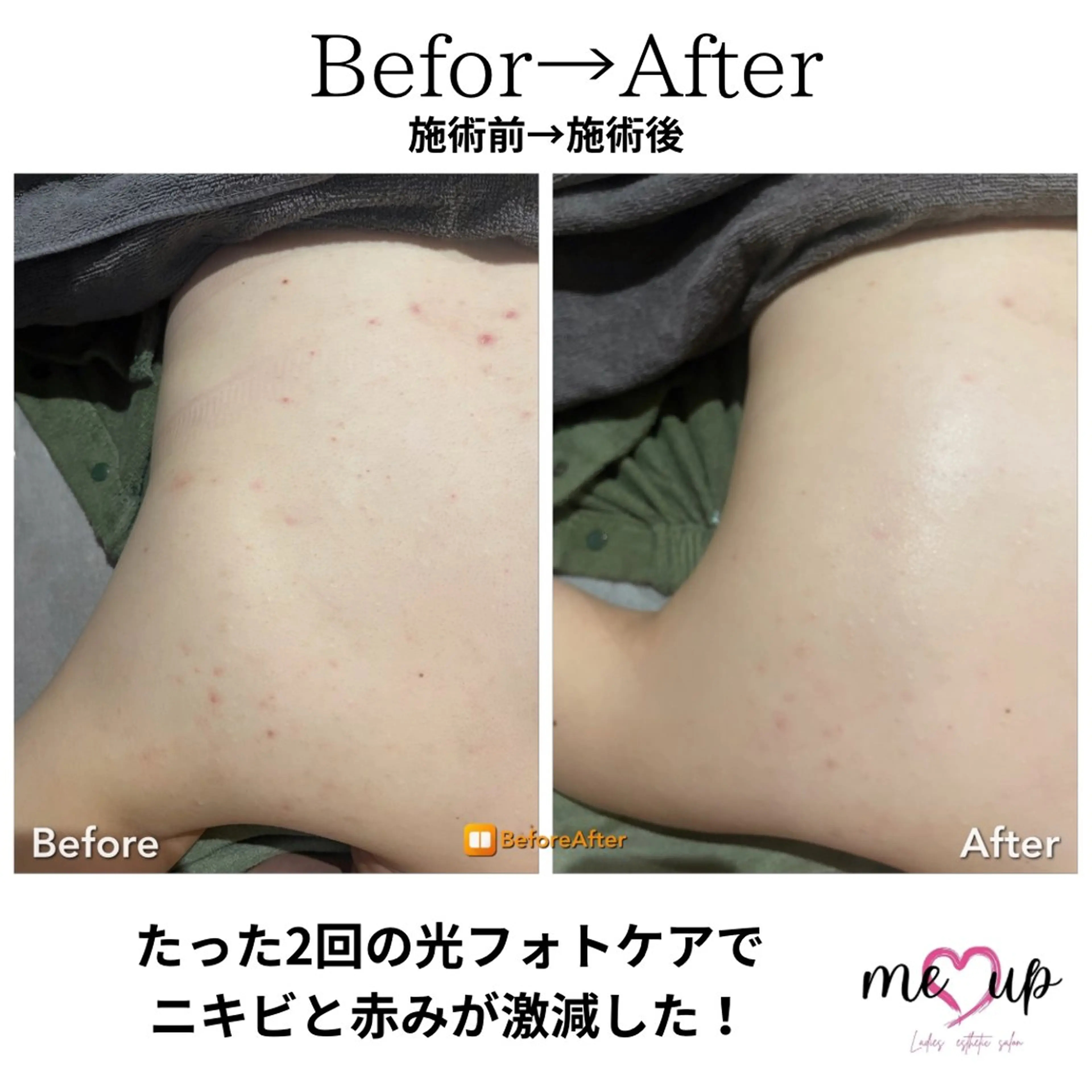 エステ Meupニキビ専門店 背中/ハーブ/ララのその他イメージ