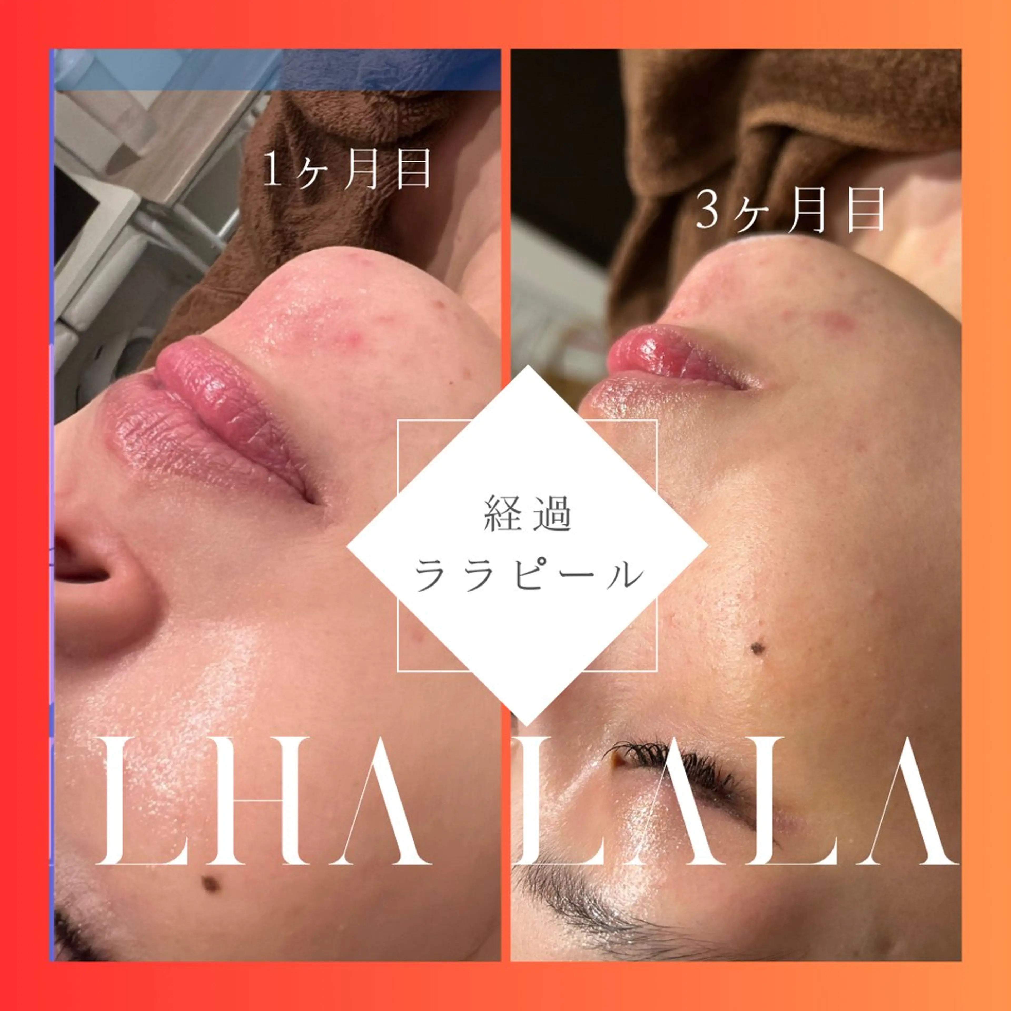 【韓国肌質管理】ララピール+超音波リフトアップ  10800円→8900円　※女性限定サロンの写真