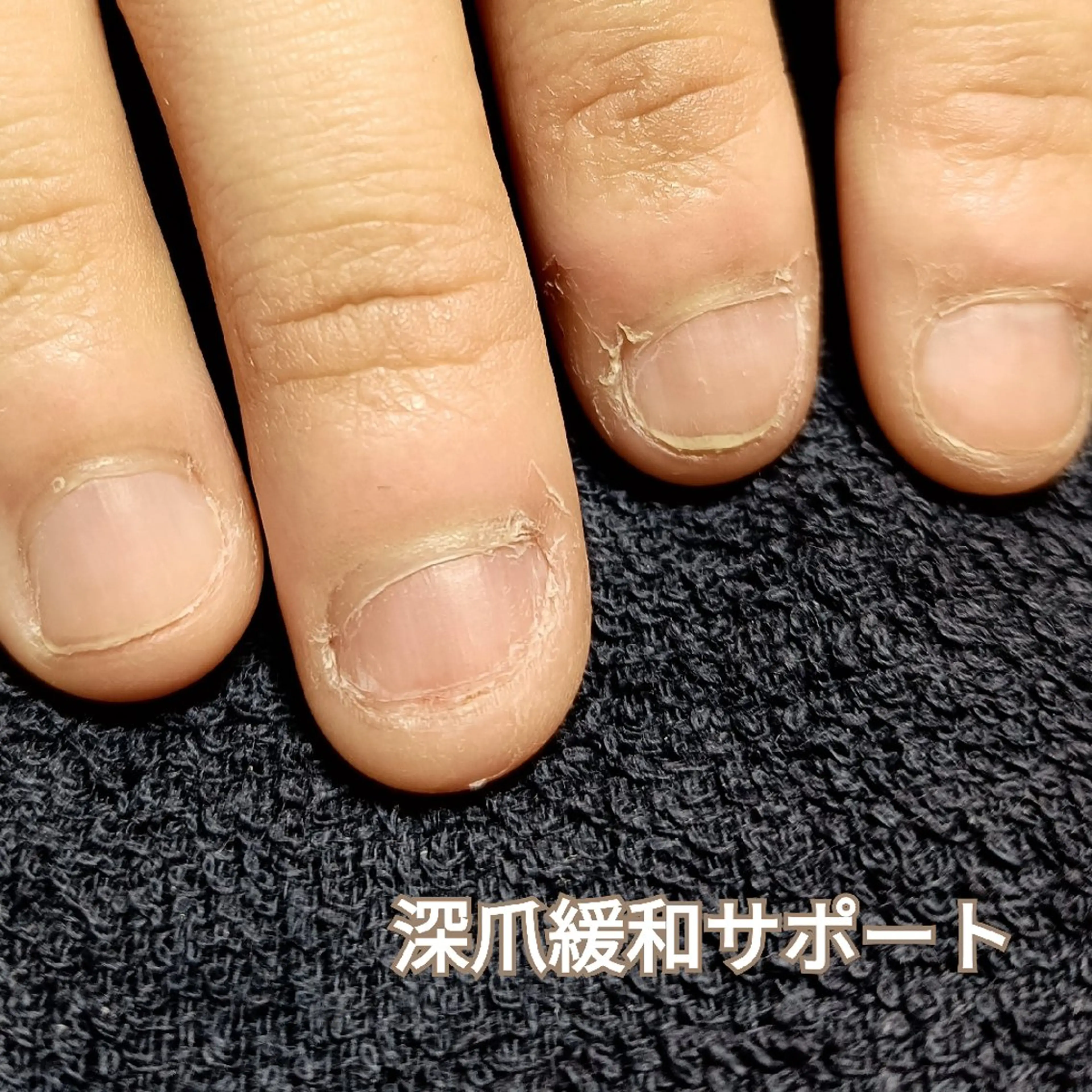ネイル 長さ出し ハンドネイル ハンドケア 深爪矯正/爪育成ケア manie nailのネイルデザイン