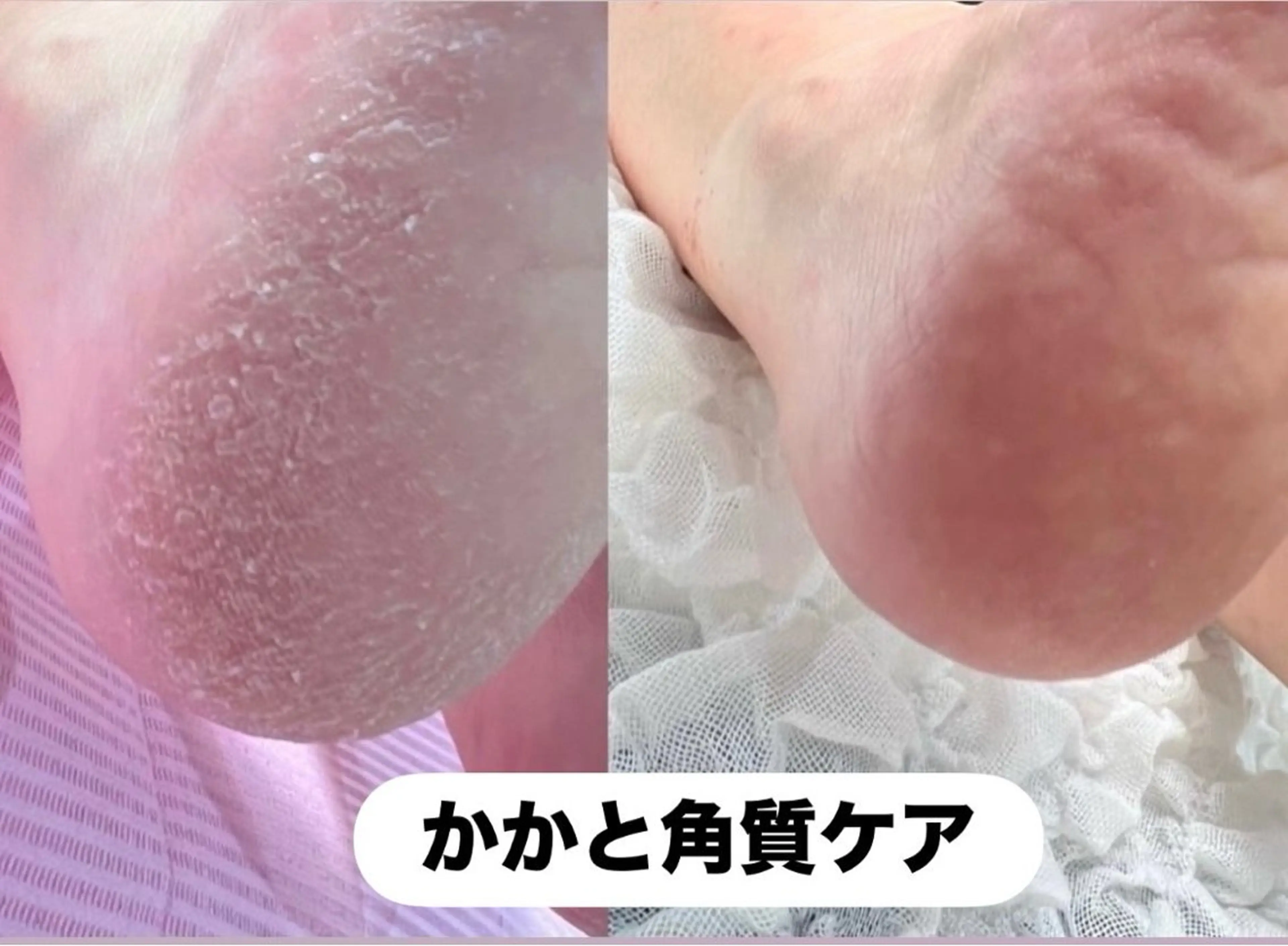 かかと角質ケア🦶✨の写真