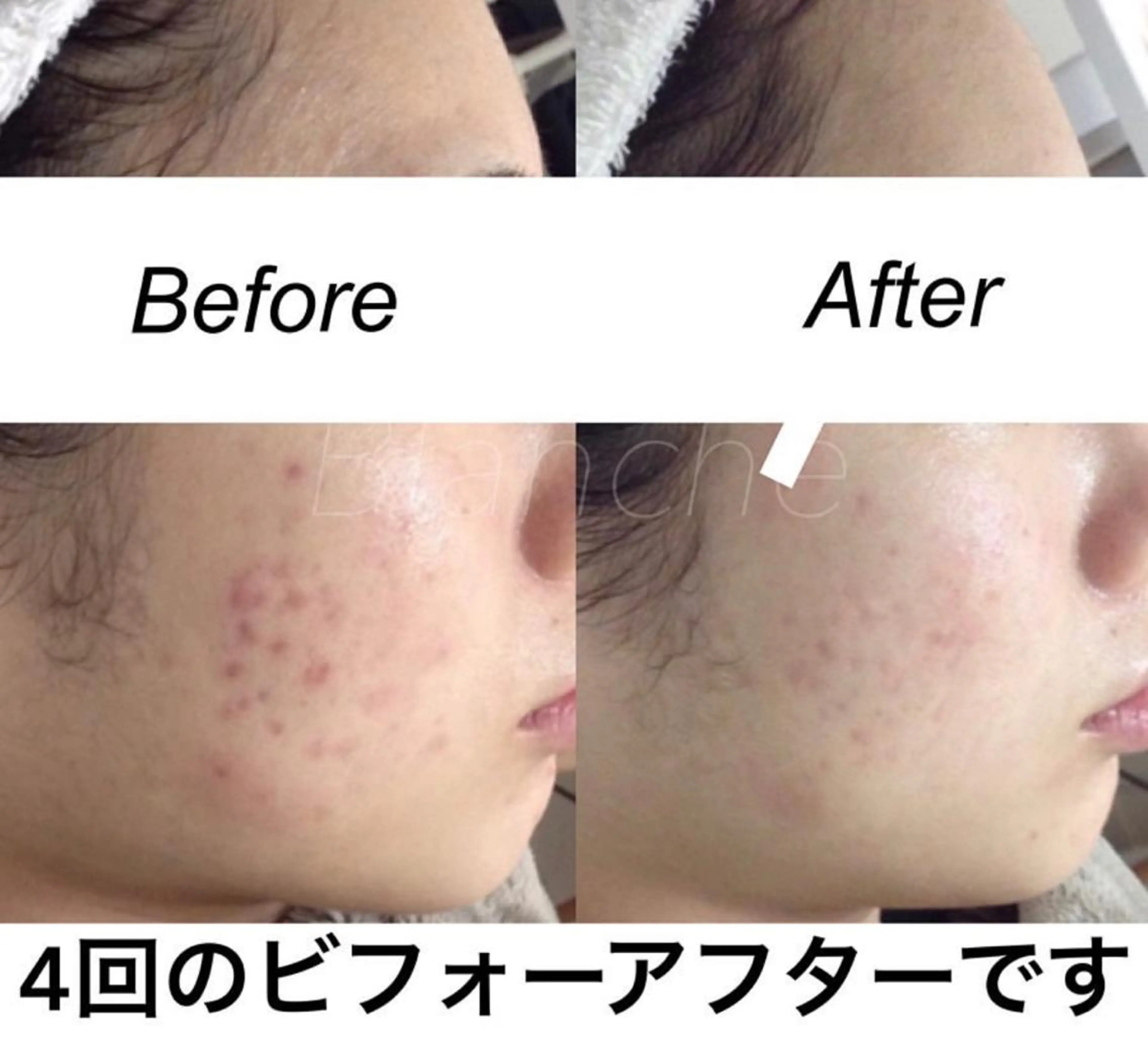 セミロング カラー パーマ ヘアアレンジ ネイル マツエク・マツパ エステ リラク 都度払い肌質改善 &脱毛Blancheのエステ・リラクイメージ