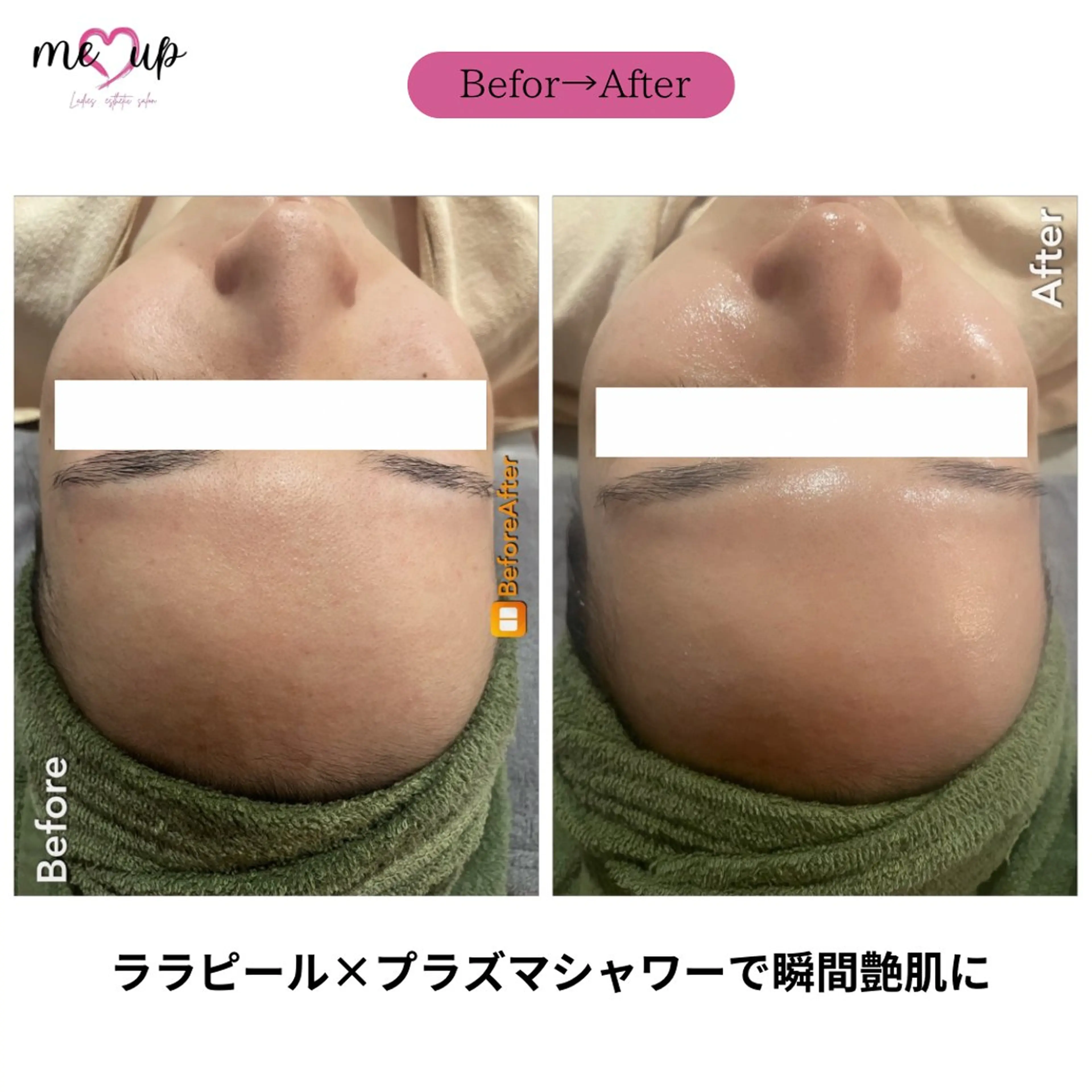 エステ Meupニキビ専門店 背中/ハーブ/ララのその他イメージ