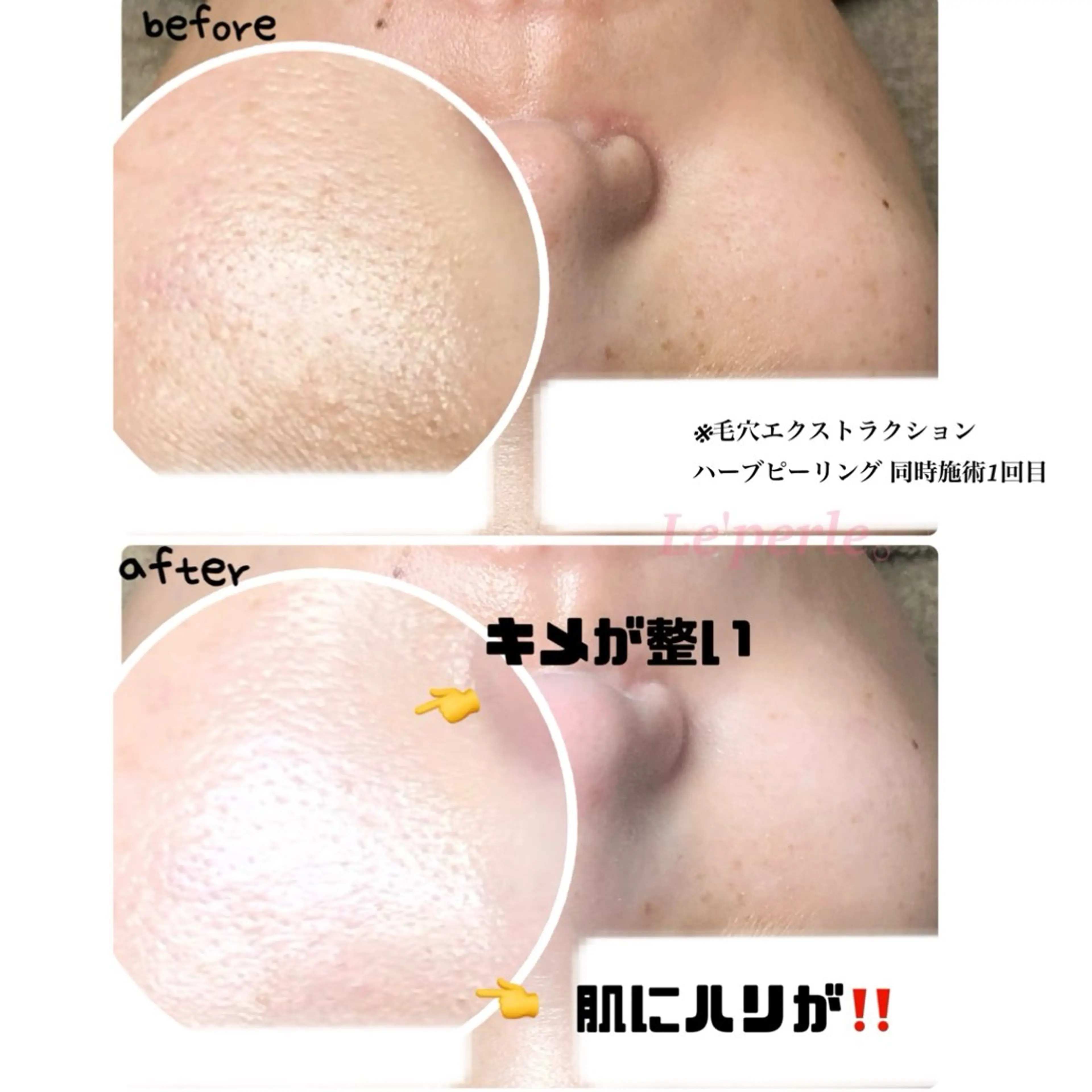 【超話題🌿剥離ナシ‼️】二刀流ハーブピーリング☆モニター様募集☆の写真