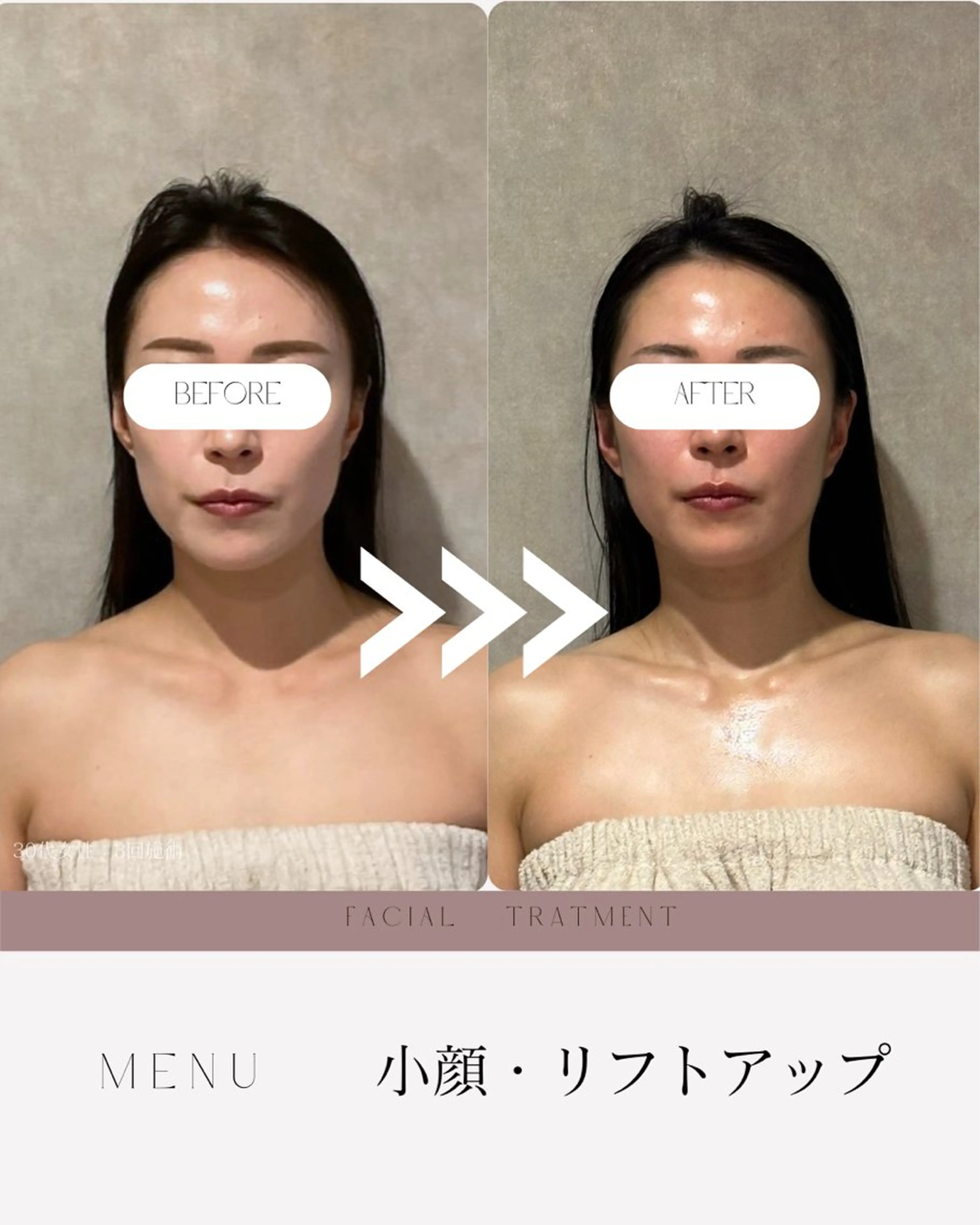 🌸人気NO1🌸🔻小顔リフトアップ✖︎造顔筋膜リリース🔻《背中・デコルテマッサージ付》※機械使用の写真