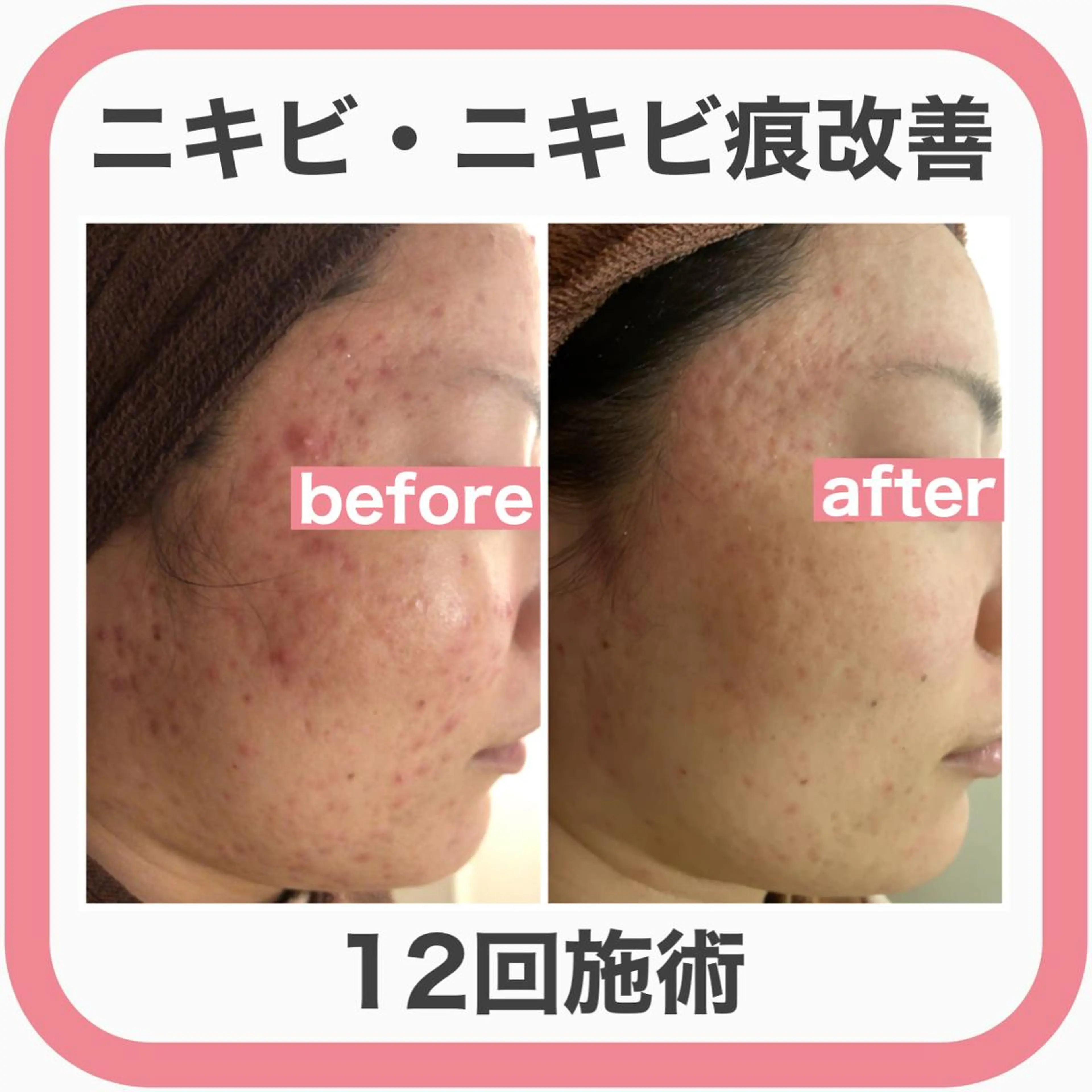 皮膚科より効果あり ⁉️最短ニキビ改善のエステ・リラクイメージ