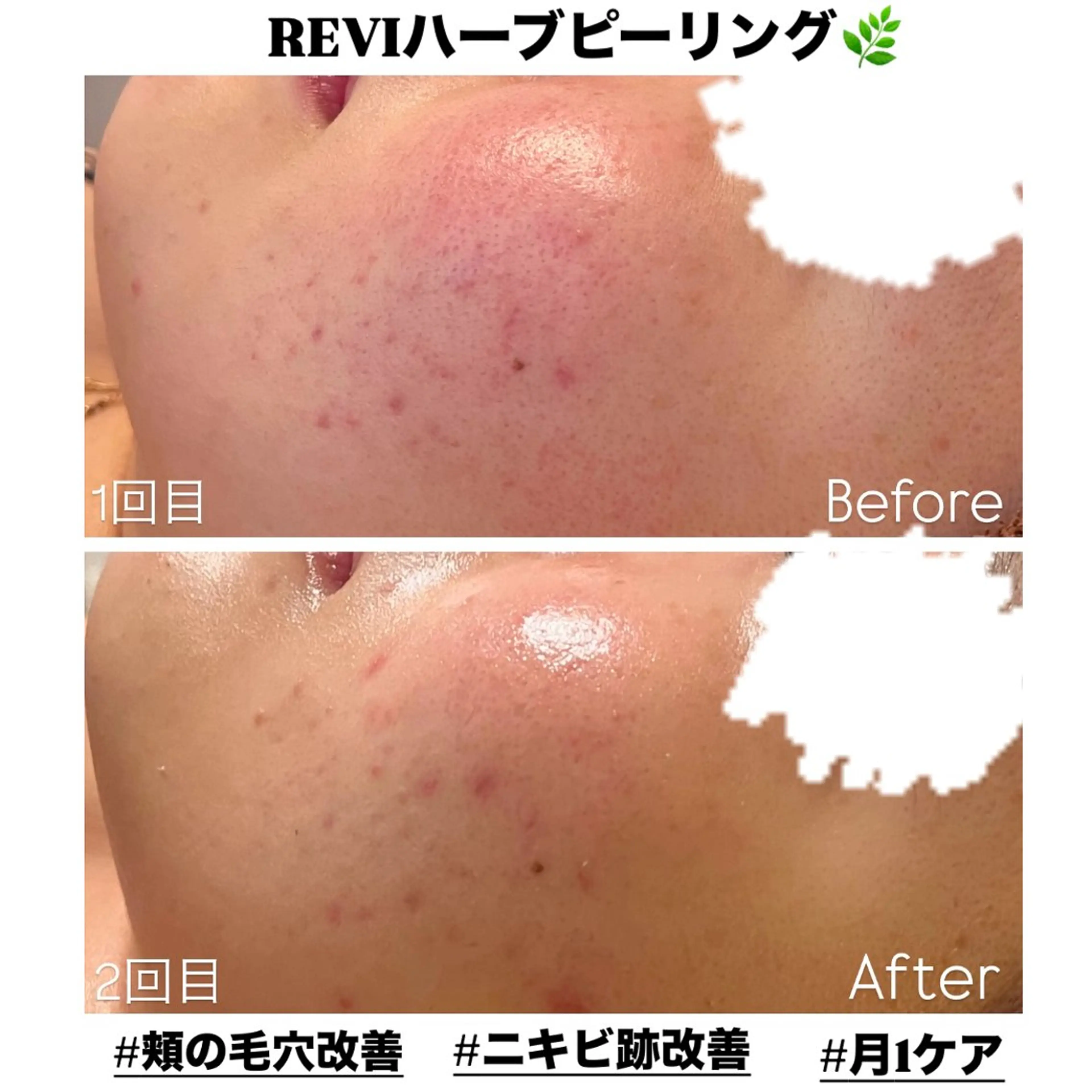 当店人気No.1メニュー✨️【 毛穴・ニキビ集中ケア 】 REVIハーブピーリング🌿の写真