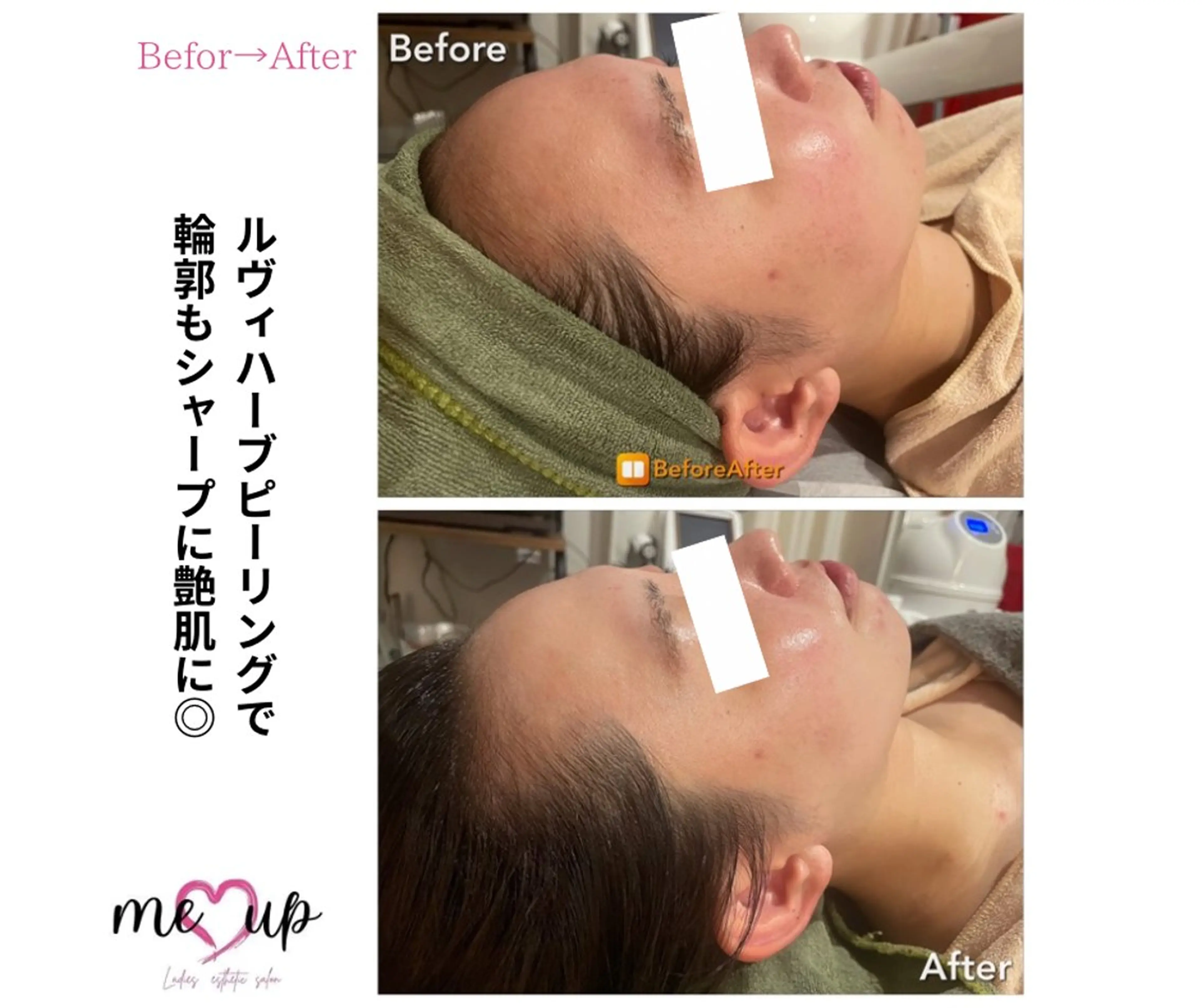 エステ Meupニキビ専門店 背中/ハーブ/ララのその他イメージ