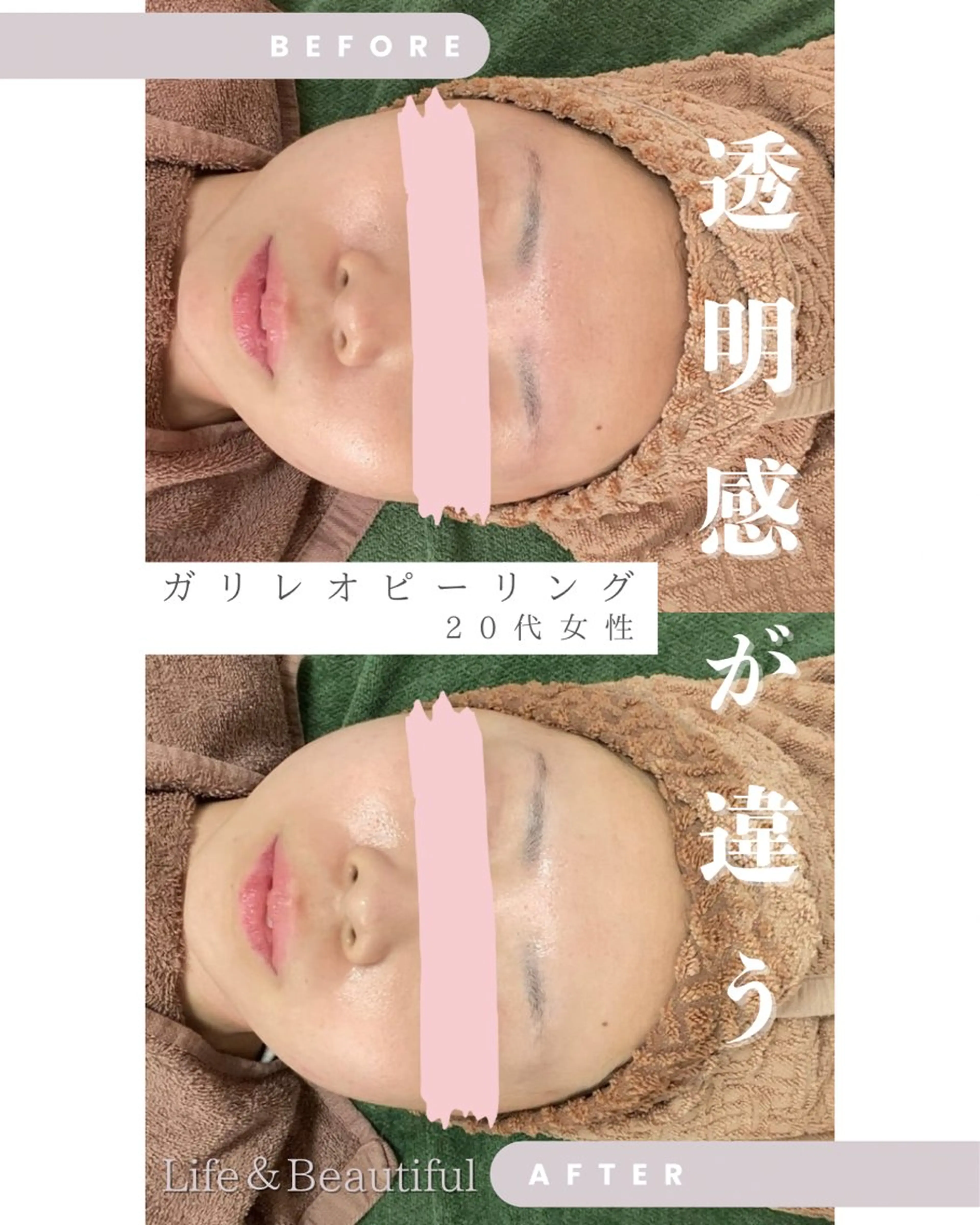 【短期間集中🌟高濃度炭酸美容液ガリレオピーリング】2回目以降❣️嬉しい！デコルテマッサージ付き❣️の写真