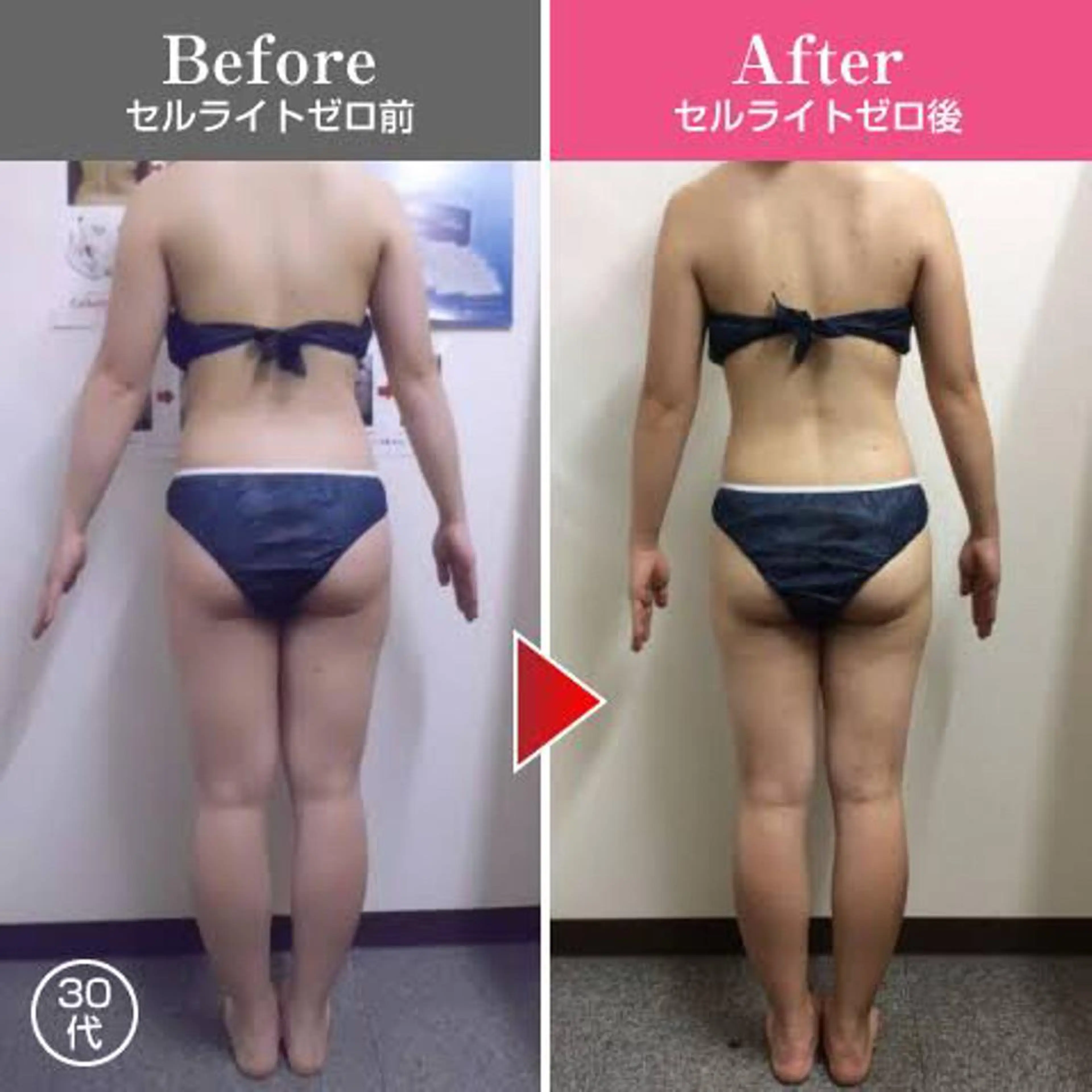 切らない脂肪吸引🔥 Neroliまりこのエステ・リラクイメージ