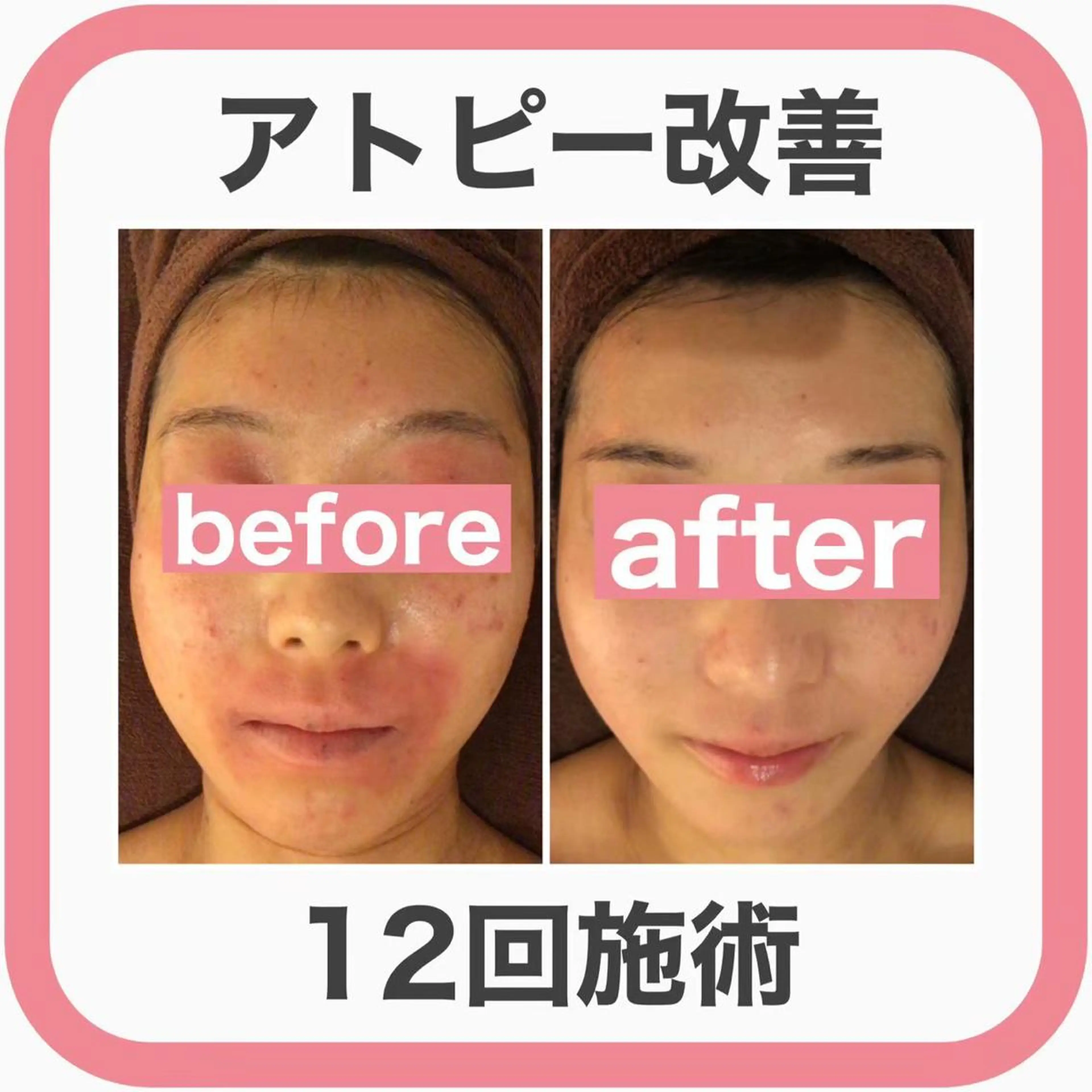 ニキビ跡改善専門🔥 医療にはできない改善のエステ・リラクイメージ