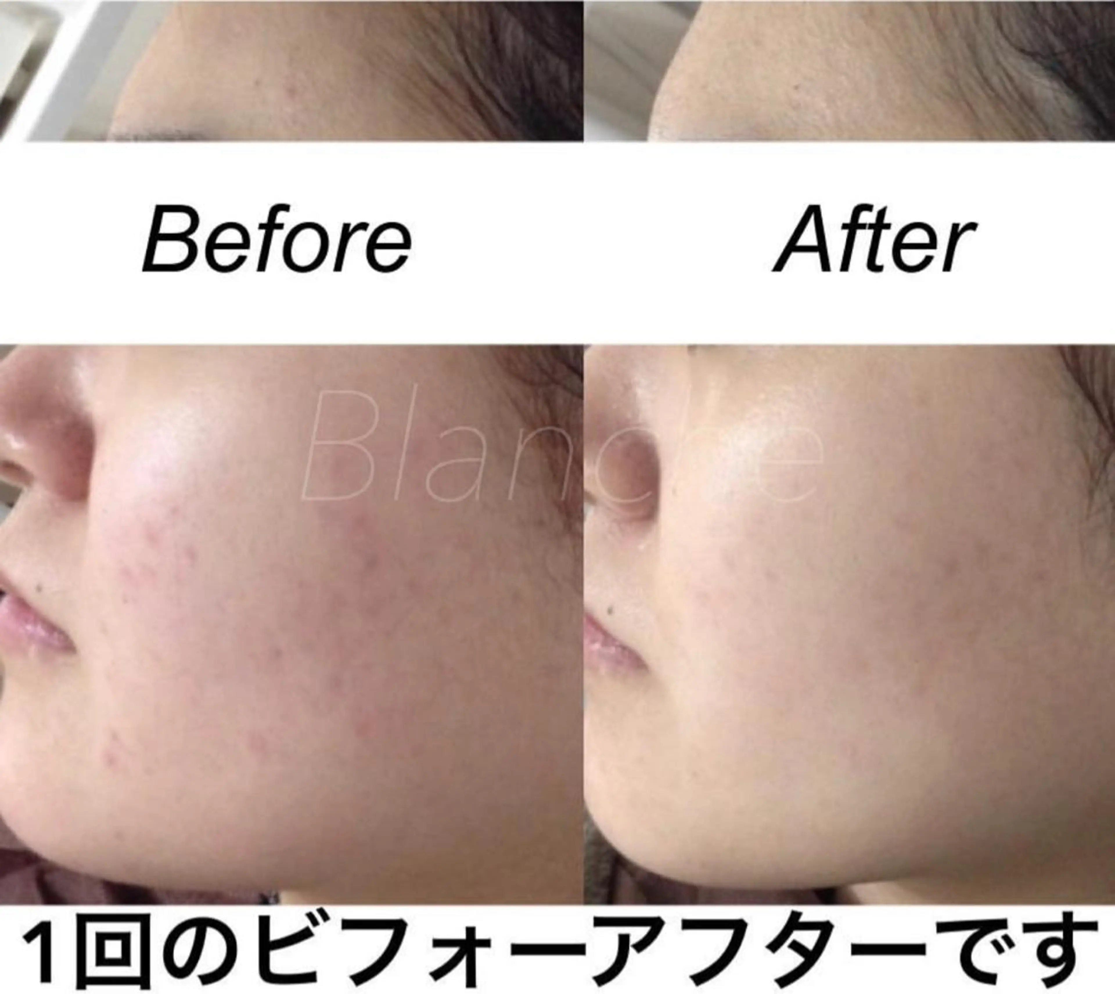 セミロング カラー パーマ ヘアアレンジ キッズ ネイル マツエク・マツパ エステ リラク 都度払い肌質改善 &脱毛Blancheのエステ・リラクイメージ