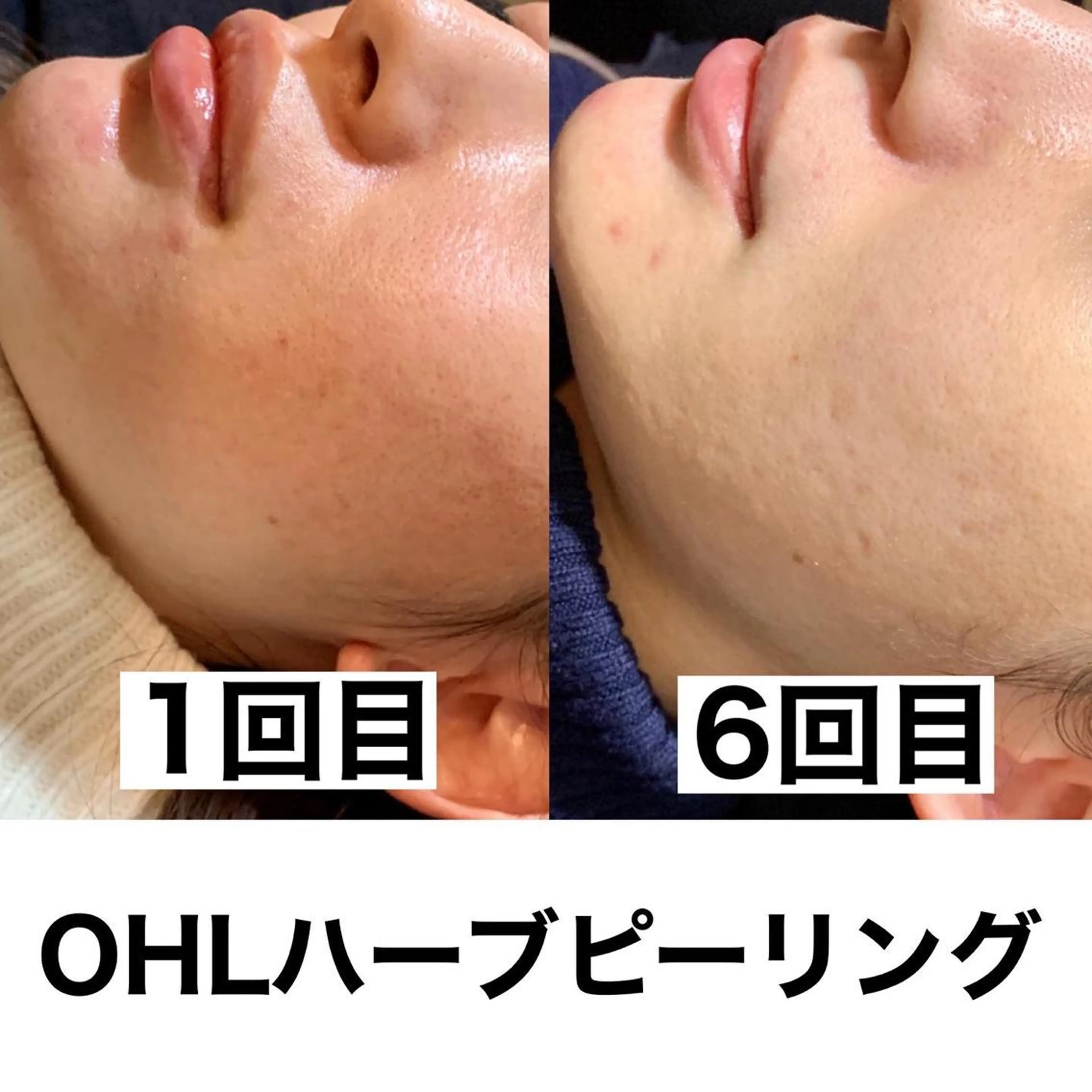 メンズ エステ リラク 姫路ハーブピーリング・韓国肌管理専門店Emotional所属・Yuka .のエステ・リラクイメージ