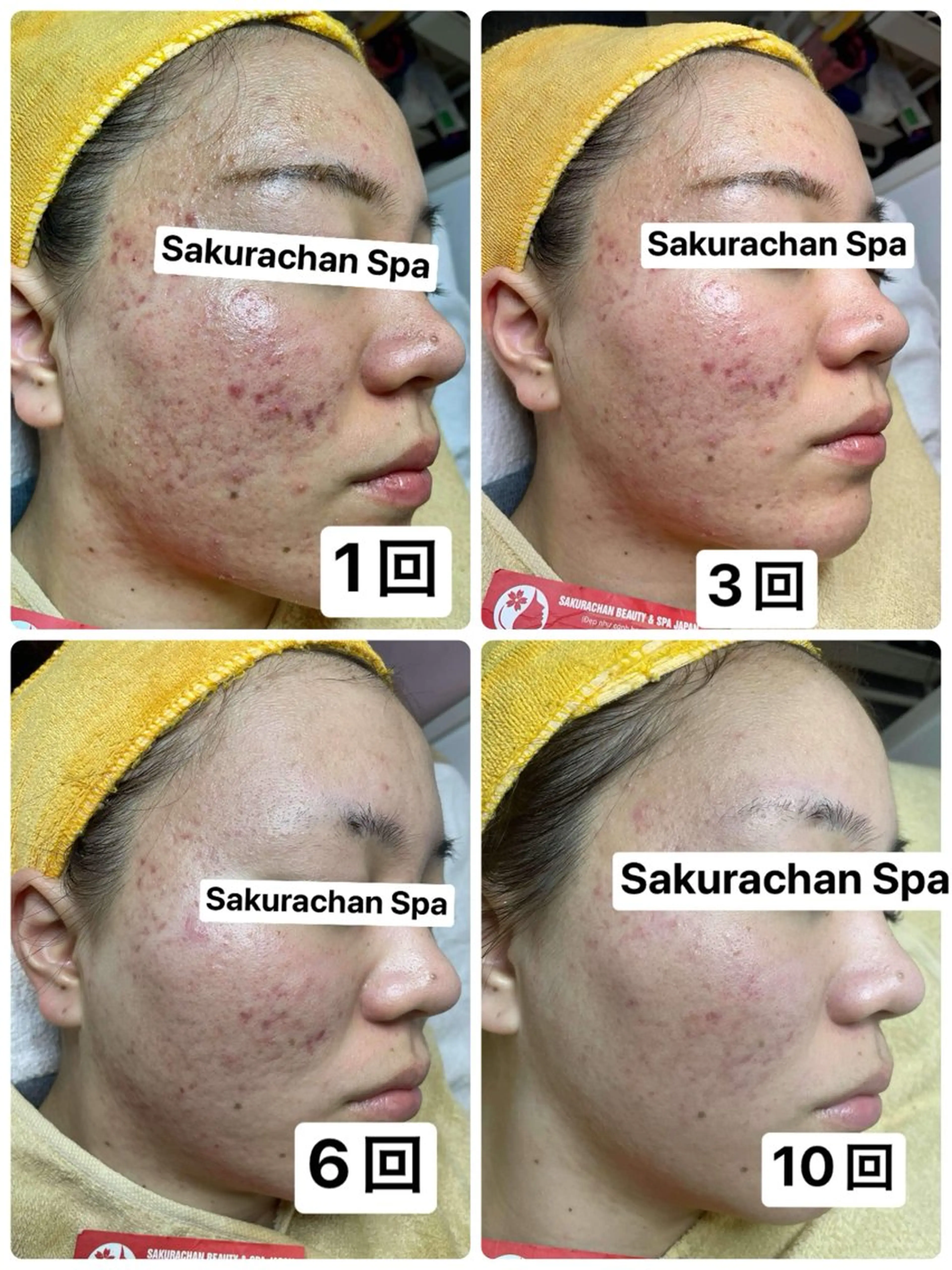 ニキビ、痩身、脱毛、 サクラチャンスパのエステ・リラクイメージ